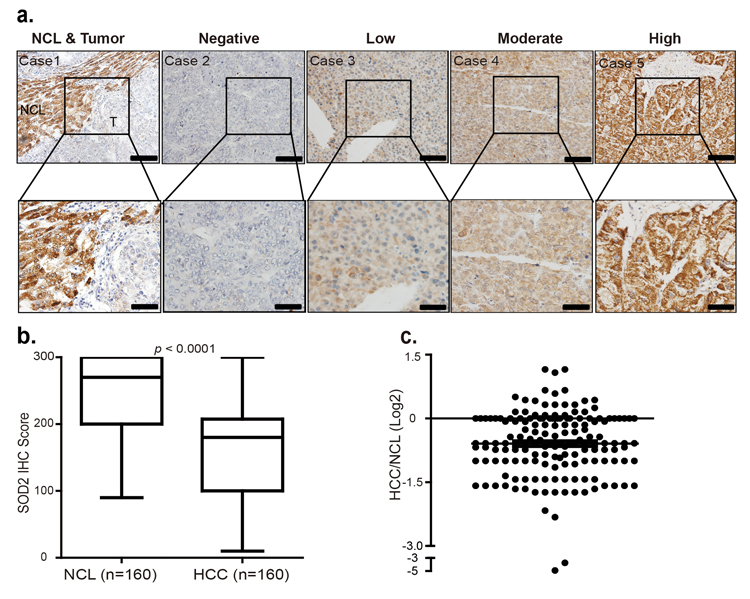 SOD2 protein level is decreased in primary human HCC tissues