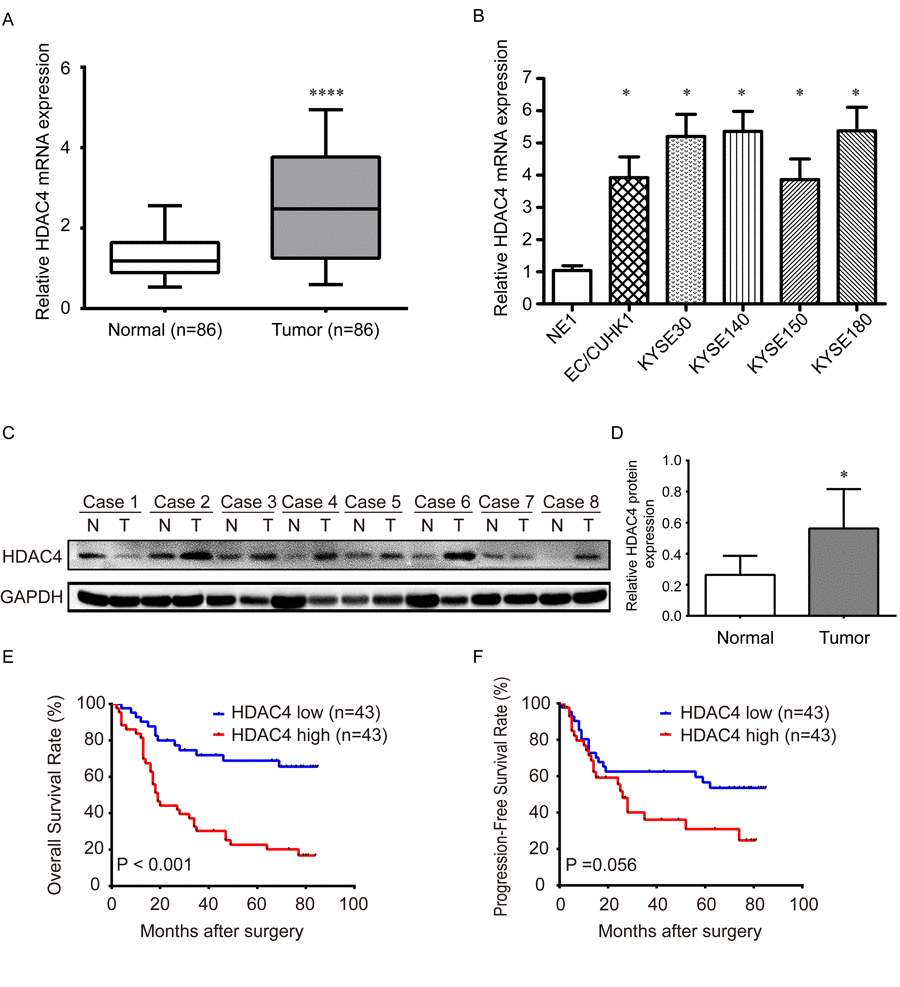 The expression of HDAC4 is upregulated in ESCC tissues and cell lines and associated with survival