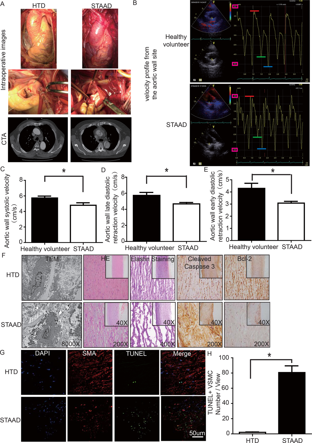 (A) Intraoperative images and CTA results showing the enlarged ascending aorta and typical true and false cavities in STAAD. (B) Echocardiography showing the Vmax of healthy volunteers and patients with STAAD (including aortic wall systolic velocity (red line), late diastolic retraction velocity (blue line) and early diastolic retraction velocity (green line)). (C) The mean aortic wall systolic velocity of the ascending aorta was significantly lower in patients with STAAD than in healthy volunteers (n=5 in healthy volunteer group, n=5 in STAAD group, *p=0.0417). (D) The mean late-diastolic retraction velocity of the ascending aorta was significantly lower in patients with STAAD than in healthy volunteers (n=5 in Healthy volunteer group, n=5 in STAAD group, *p=0.0478). (E) The mean early-diastolic retraction velocity of the ascending aorta was significantly lower in patients with STAAD than in healthy volunteers (n=5 in healthy volunteer group, n=5 in STAAD group, *p=0.0407). (F) TEM showed partly fragmented and reduplicated elastic lamina and abnormal VSMCs, together with an electron-dense amorphous material peripheral cell membrane in the ascending aortic wall of patients with STAAD, H&E and elastin staining showed obvious ascending aorta tissue structure disorganization in patients with STAAD, and immunohistochemistry showed that cleaved caspase-3 was present at high levels and bcl-2 was present at low levels in the ascending aortic wall of patients with STAAD relative to that of HTDs. (G, H) Confocal fluorescence microscopy showed that the numbers of double stained (TUNEL and α-SMA) cells was higher in the ascending aortic wall of patients with STAAD (n=19 in HTD group, n=23 in STAAD group, *p=0.0009).