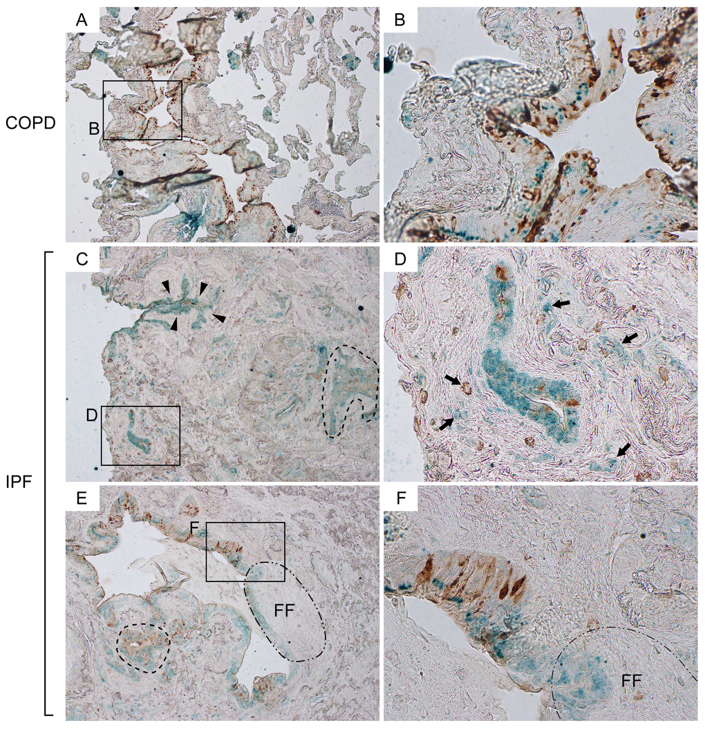 Attenuation of CCSP expression in bronchiolar epithelium are associated with interstitial fibrosis and formation of fibroblastic foci in IPF lungs. Paraffin-embedded lung sections from patients with idiopathic pulmonary fibrosis (IPF) and chronic obstructive pulmonary fibrosis (COPD) were immunohistochemically double-labeled for club cell secretory protein (CCSP) and Claudin-10 (Cldn10). Brown and green signals correspond to CCSP and Cldn10 respectively. (A, B) Representative photomicrographs from COPD lungs display an area which shows colocalization of the two signals in bronchiolar epithelium (B). Solely Cldn10-positive club cells are seen in slightly affected alveoli (A). (C, D) Photomicrographs of highly fibrotic lesions from IPF lungs are shown. CCSP signals are scarcely scattered. Dashed-line in (C) denotes a distinct area with CCSP- and/or Cldn10-positve club cells having occluded a bronchiolar lumen. Arrows in (D) denote club cells blended with the surrounding fibrotic interstitium. (E, F) Photomicrographs of a widely open bronchiolar lumen and surrounding fibrotic interstitium from IPF lungs are shown. Dashed-line in (E) denotes an area with club cell hypercellularity. Area circled by dot-dashed line (FF) denotes fibroblastic foci. Luminal side of fibroblastic foci is lined by CCSP-negative Cldn10-positive club cells (E) whereas the adjacent bronchiolar epithelium exhibits both signals (F). Original magnifications: x40 (A, C, E); x400 (B, D, F).
