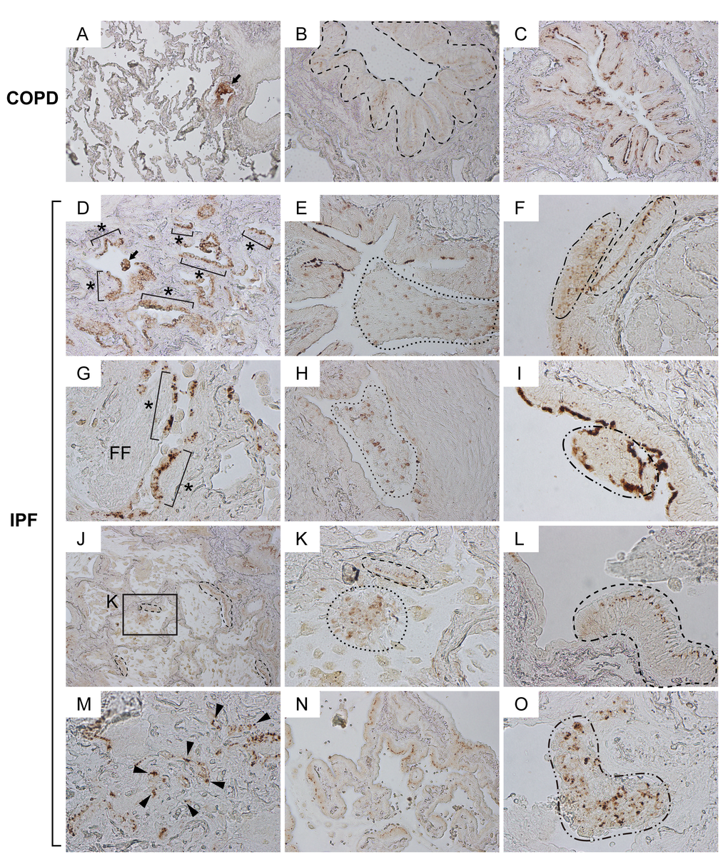 Claudin10-positive cells with marked pleomorphism are widely distributed in various patterns in IPF lungs. Paraffin-embedded lung sections from patients with IPF and COPD were immunohistochemically labeled for Cldn10. Brown signals correspond to Cldn10. (A, B, C) Representative photomicrographs of normal-looking alveoli with slightly remodeled bronchiolar region (A) and bronchiolar regions (B, C) from COPD lungs are shown. Despite the variation of subcellular localization of Cldn10, Cldn10-positive cells mostly displayed organized cell arrangements. Arrow in (A) denotes cytoplasmic and/or nuclear expression of Cldn10 in the cells at terminal (or respiratory) bronchiole. Dashed-line in (B) encompasses bronchiolar epithelium in which Cldn10 signals are confined to the uppermost portion of the lateral membrane between the epithelial cells, apparently corresponding to tight junctions. Cldn10 expression was occasionally spotted at luminal end of the bronchiolar epithelium (C). (D-O) Representative photomicrographs with different arrangements of Cldn10-positive cells are shown. (D) Asterisks denote Cldn10-positive epithelial monolayers in a moderately fibrotic region. Arrow denotes a cellular mass in the airspace containing Cldn10-positive cells. (E) Area circled by dotted line denotes mosaic cell mass in the airspace containing Cldn10-positive and negative cells. (F) Two different arrangements of club cells were juxtaposed with each other; one with organized columnar cells expressing Cldn10 at the uppermost portion of the lateral membrane between the epithelial cells (area circled by dashed line) and the other with mosaic mixtures of Cldn10-positive and negative cells (area circled by dot-dashed line). (G) Asterisks denote Cldn10-positive epithelial monolayers. Luminal side of fibroblastic foci (FF) is lined by Cldn10-positive and negative cells with round-to-oval shape. (H) Area circled by dotted line denotes a mosaic cell mass containing Cldn10-positive and negative cells. Highly fibrotic area is located to the right of the mass, where Cldn10 signals are barely observed at the luminal edge. I: Area circled by dot-dashed line denotes a polypoid cell mass containing Cldn10-positive and negative cells. (J) Area with honeycomb change display multiple cysts lined by Cldn10-positive club cell monolayers. (K) Magnified view of the boxed region in (J) display a mosaic cell mass in the airspace containing Cldn10-positive and negative cells (area surrounded by dotted line) and Cldn10-positive monolayer that partially line the cyst wall (area surrounded by dashed line). (L) Area surrounded by dashed line denotes columnar club cells forming organized monolayer. The expression of Cldn10 is confined to the uppermost portion of the lateral membrane between the epithelial cells, apparently at tight junctions. Adjacent bronchiolar epithelium to the left is lined by cuboidal epithelial cells negative or weakly positive for Cldn10. (M) Fibrotic interstitium with Cldn10-positive club cells randomly distributed therein. Numerous Cldn10-negative cuboidal cells are also spotted in the vicinity of Cldn10-positive cells. (N) Cldn10-positive club cells with oval-to-columnar shape populate the alveolar wall in a monolayer arrangement. (O) Area circled by dot-dashed line denotes a mosaic cell mass containing Cldn10-positive and negative cells. The mass barely attaches to the lung structure located to the right. Original magnifications: x100 (A, J); x200 (B, C, D, E, H, N); x400 (F, G, I, K, L, M, O).