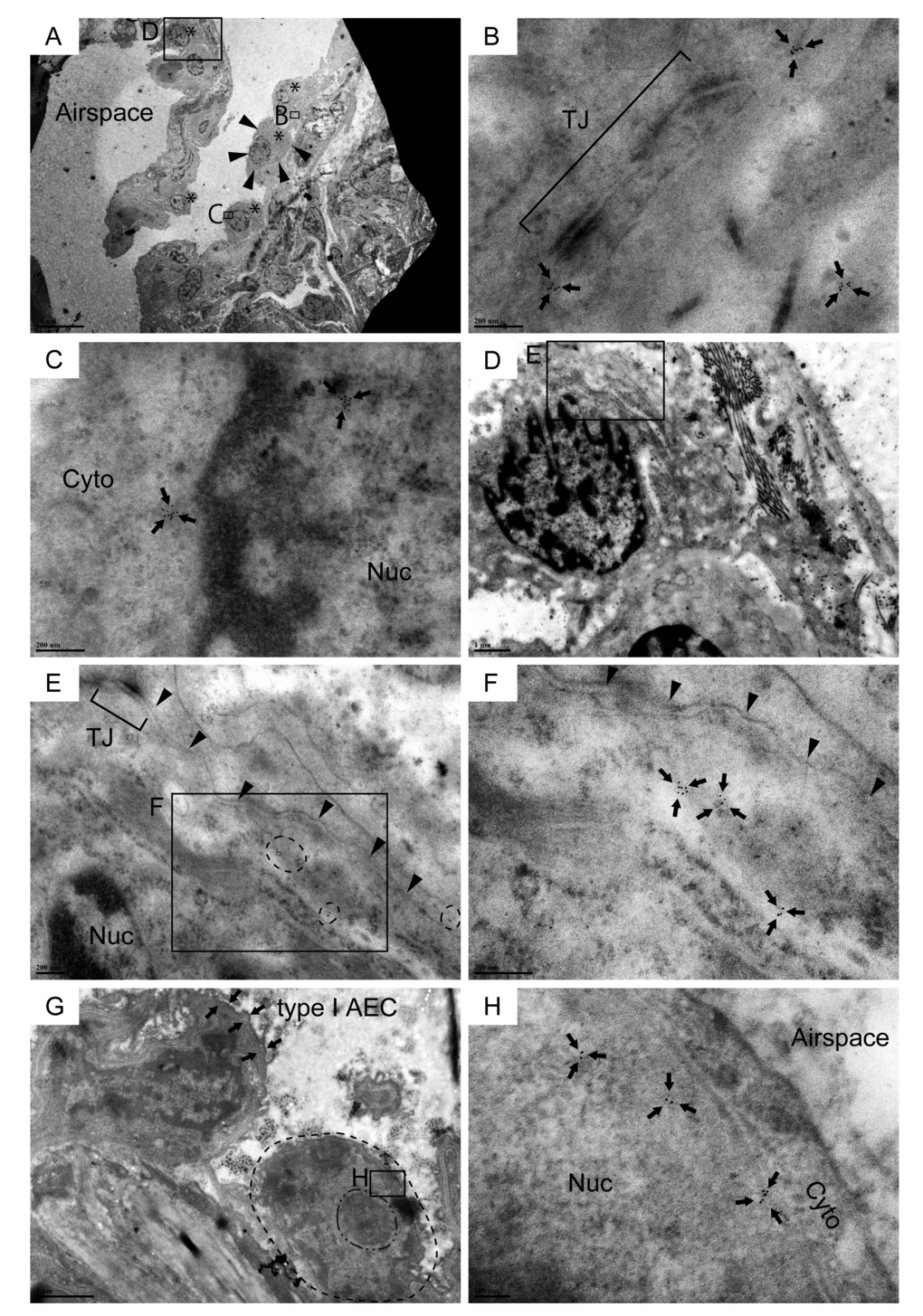 Cldn10-positive cells with cuboidal to oval shape line the alveolar epithelium in IPF lungs. Resin-embedded lung sections from patients with IPF were labeled for Cldn10 using immunogold labeling method. Arrows in (B, C, F & H) denote Cldn10 signals. (A) Alveolar epithelium with mild fibrosis is lined by a monolayer of metaplastic epithelial cells with cuboidal to oval shape (Asterisks). (B) Cldn10 expression (arrows) are located in close proximity to the tight junction (TJ) between the two adjacent cells. Note that the the Cldn10 signals shown belong to the epithelial cell circled by arrowheads in (A). (C) Cldn10 expression (arrows) are located in the cytoplasm (Cyto) and nucleus (Nuc). Additional photomicrographs showing the spatial association of this cell with the subjacent fibroblast are presented in Supplemental Figure S3F, G and H. (D, E, F) Cldn10 expression (tiny black dots in areas circled by dashed lines in (E) and arrows in (F) are located near the lateral membrane (the boundary between the two adjacent epithelial cells is designated by arrowheads in (E & F). The Cldn10 signals are not located near to the tight junction (TJ in E). Note there is a deposition of collagen bundles in the subjacent interstitium of the Cldn10-positive epithelial cell (D). (G, H) Alveolar epithelium lined by a cuboidal cell with nuclear expression of Cldn10. (G) Dot-dashed and dashed line are respectively drawn slightly outside the nucleolus and cytoplasmic membrane of the cuboidal cell. Note that the cell displays large nucleus-to-cytoplasm (N/C) ratio and huge nucleolus. (H) Magnified view of the boxed region in (G) displays nuclear expression of Cldn10. Original magnifications: x2,000 (A); x100,000 (B, C); x15,000 (D); x60,000 (E); x120,000 (F); x12,000 (G); x150,000 (H);