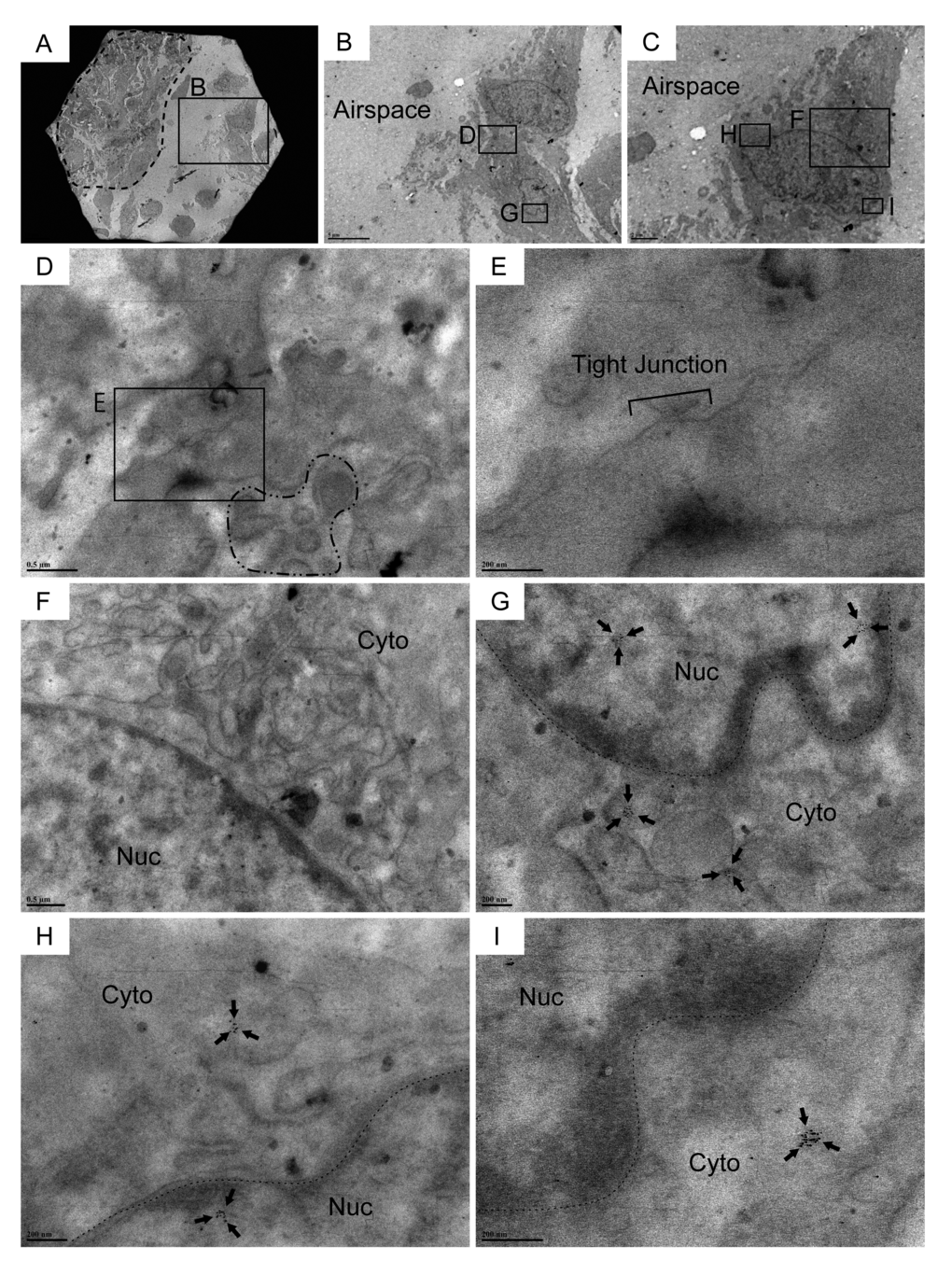 Cldn10-positive cells encompassing traces of subcellular structures of club cells are observed in the airspace of IPF lungs. Resin-embedded lung sections from patients with IPF were labeled for Cldn10 using immunogold labeling method. Arrows in (G, H & I) denote Cldn10 signals. (A, B) Two adjacent cells (within the boxed region in A) are spotted in the airspace off from the fibrotic interstitium to the left (area circled by dashed line in (A). Note that the two adjacent cells shown in (B) are connected. (C) One of the two adjacent cells display elongated oval shape. (D, E, F) Two adjacent cells are barely connected at lateral membrane, apparently via tight junction (E). Cldn10 is absent in the tight junction (D & E). Presence of granules in the cytoplasm of one cell is noted (area surrounded by dot-dashed line in (D). The other cell displays a well-developed network of endoplasmic reticulum (F). (G) Magnified view of the boxed region in (B) displays cytoplasmic and nuclear expression of Cldn10. (H, I) Magnified views of the boxed regions in (C) display cytoplasmic (H, I) and nuclear (H) expression of Cldn10. Original magnifications: x1,500 (A); x5,000 (B); x8,000 (C); x30,000 (F); x40,000 (D); x60,000 (G); x80,000 (H); x120,000 (E, I).