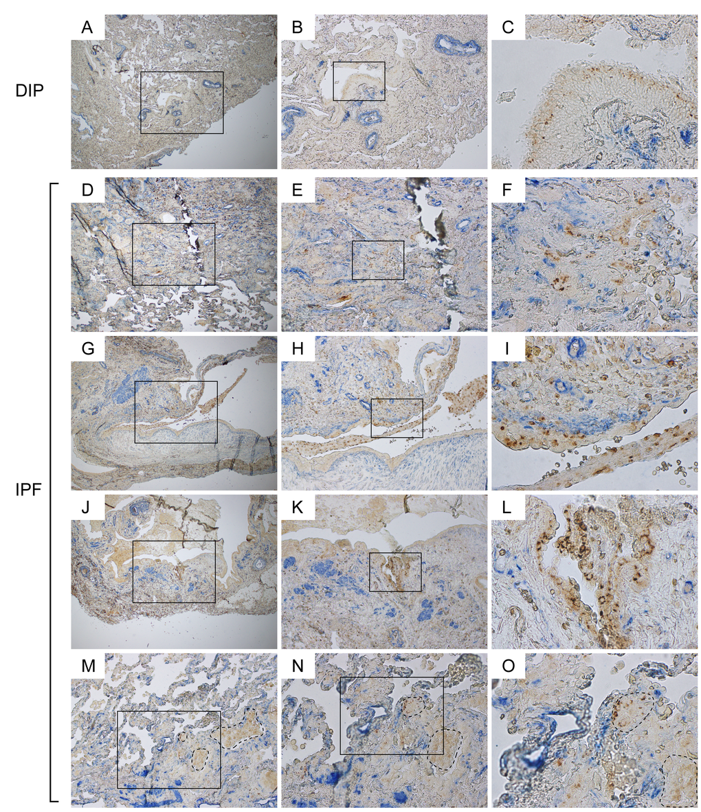 Aberrant α-SMA signals are frequently encountered in the vicinity of disorganized Claudin-10-positive cells in IPF lungs. IPF and DIP lung sections were immunohistochemically double-labeled for Cldn10 and α-SMA. Brown and blue signals correspond to Cldn10 and α-SMA respectively. (B, E, H, K, N) are magnified views of the boxed regions in (A, D, G, J, M) respectively. (C, F, I, L, O) are magnified views of the boxed regions in (B, E, H, K, N) respectively. (A, B, C) Representative photomicrographs from DIP lungs are shown. α-SMA signals are largely spotted beneath the arterial walls, where smooth muscle cells typically reside. No aberrant proximity is seen between Cldn10-positive cells and α-SMA signals. (D, E, F) Fibrotic interstitium showing aberrant α-SMA signals in close proximity to Cldn10-positive club cells. Note the juxtaposition of Cldn10-negative cuboidal cells with Cldn10-positive cells and aberrant α-SMA signals (F). (G, H, I) Mosaic cell masses containing Cldn10-positive and negative cells are floating in an enlarged airspace. Cldn10-positive club cells infiltrating the fibrotic interstitium (I). (J, K, L) Cldn10-positive club cells form multilayers in bronchiolar epithelium (L) in close proximity to intense α-SMA signals (K). (M, N, O) Boundary region between normal-looking alveoli and moderately affected area with thickened interstitium is shown. Areas surrounded by dashed lines denote mosaic cell masses containing Cldn10-positive and negative cells. Apparently, those cell masses have occluded the alveolar airspaces. Original magnifications: x40 (A, D, G, J); x100 (B, E, H, K, M); x200 (N); x100 (C, F, I, L, O).