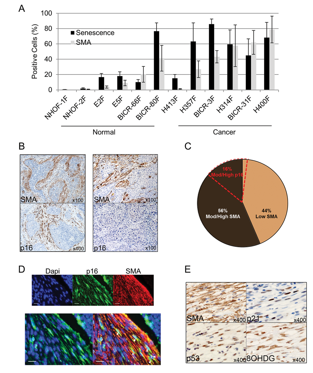 Senescent CAF analyzed ex vivo and in vivo are predominantly SMA-positive. (A) Histogram showing percentage of cells positive for senescence-associated (SA)-β-Galactosidase or SMA-positive stress fiber formation in normal oral fibroblasts (POF) and cancer-associated oral fibroblasts (CAF) grown ex-vivo. Data are presented as Mean ±SEM from 6 POFs and 6 CAF. (B) Representative images of immunohistochemistry on sequential tissue sections of SMA-positive/p16-positive or SMA-positive/p16-negative HNSCC cases. (C) Pie chart showing the percentage of HNSCC cases with stromal staining for SMA or p16. (D) Representative image of double immunofluorescence staining of a p16-positive/SMA-positive HNSCC case showing co-expression of SMA (red) and p16 (green, white arrows; scale bars represent 25µm). (E) Representative immunohistochemistry for SMA and markers of senescence (p53, p21) and oxidative stress (8-OHDG) on sequential tissue sections of HNSCC. See also Supplementary Fig. S2.