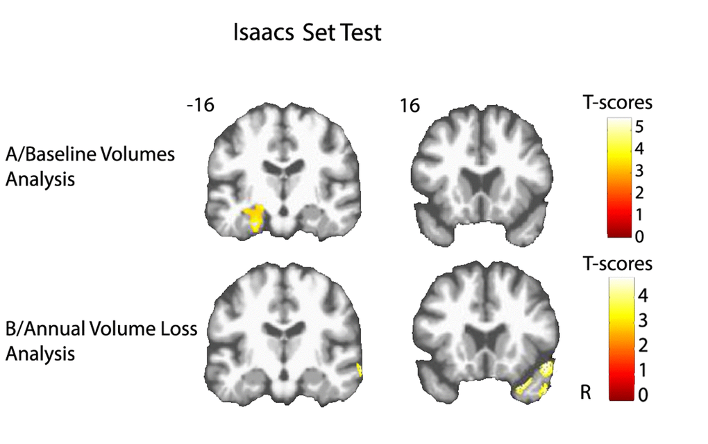 Cerebral substratum of semantic fluency decline. (A) Transversal VBM analysis: grey matter volumes at baseline and fluency decline. (B) Longitudinal VBM analysis: grey matter annual rates of atrophy and fluency decline. Each model was adjusted for age, sex, level of education, APOE4 allele carrier status and total intracranial volume (except for longitudinal VBM analysis). Clusters presenting statistically significant associations (q