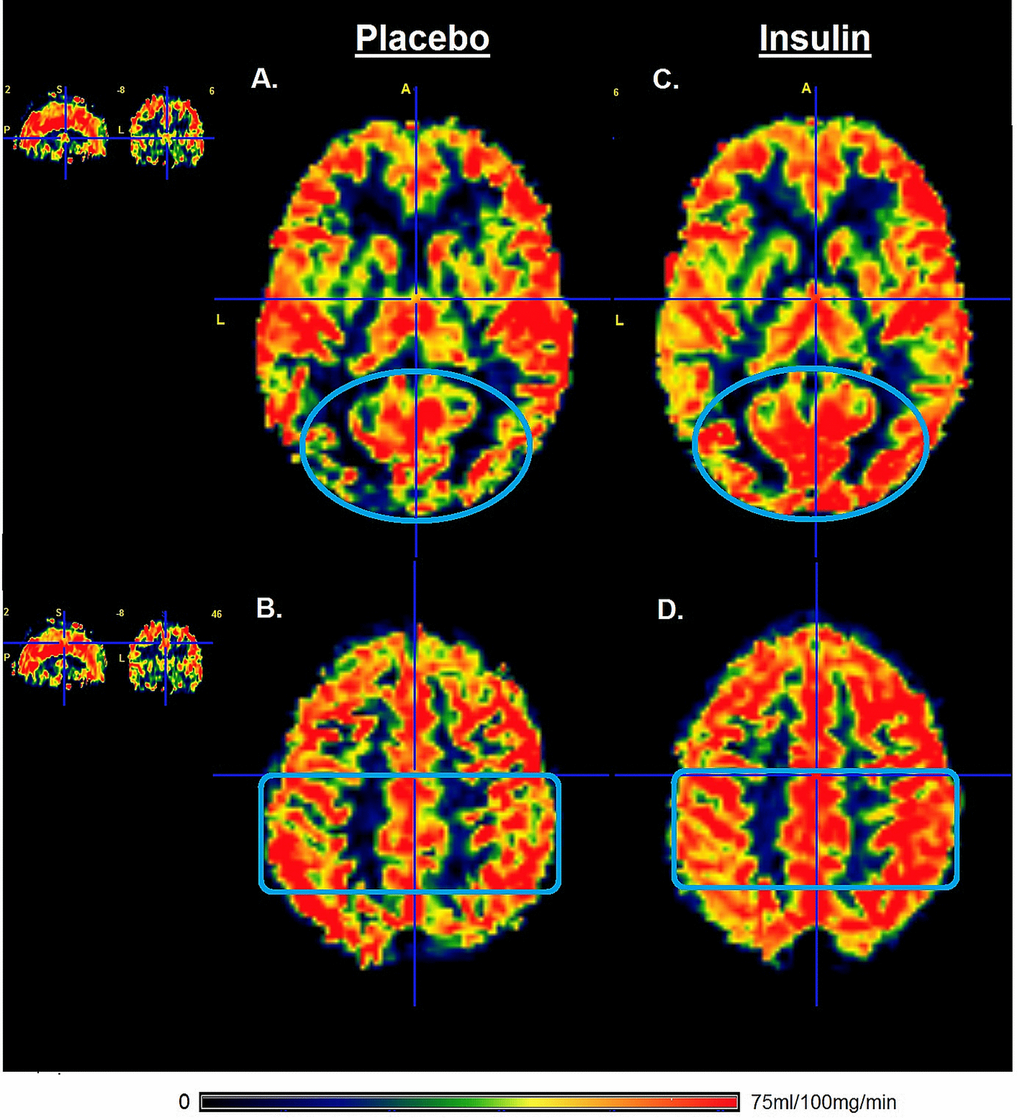 Gray matter perfusion maps after intranasal administration of placebo and insulin. Left panel (A and B) represents the gray matter perfusion map after intranasal placebo administration and the right panel (C and D) the perfusion map after intranasal insulin administration for one representative older participant. The top row shows an increase in the gray matter perfusion of occipital lobe (illustrated by blue oval) after intranasal administration of insulin compared to placebo. The bottom row shows an increase in gray matter perfusion in the parietal lobe (illustrated by blue rectangle) after intranasal administration of insulin compared to placebo. Only the gray matter was included for calculation of perfusion after intranasal administration of insulin compared to placebo.