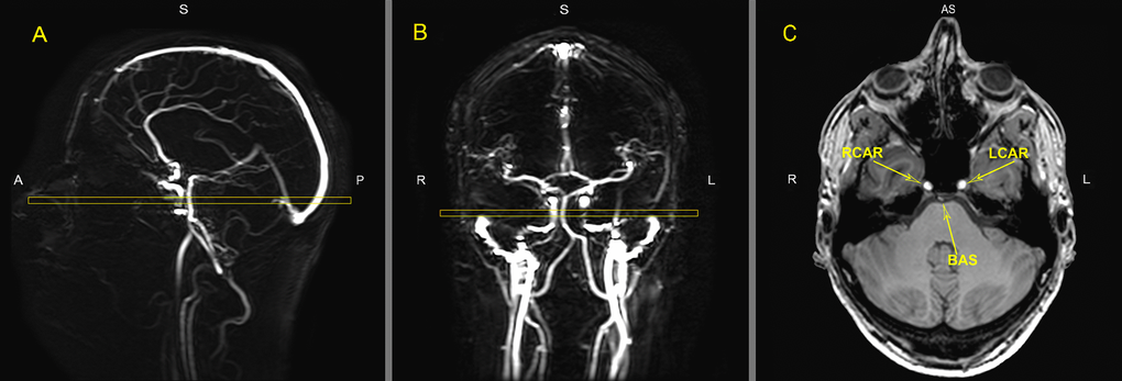 MR images of the vasculature measured with phase contrast MR angiography imaging for Quantitative Flow (QF). Typical placement of the QF phase-contrast slice (C) through the right internal carotid artery (RCAR), left internal carotid artery (LCAR) and the basilar artery (BAS) using the sagittal (A) and coronal (B) localizer angiograms. ROI’s were drawn around the three arteries in slice C to measure flow.