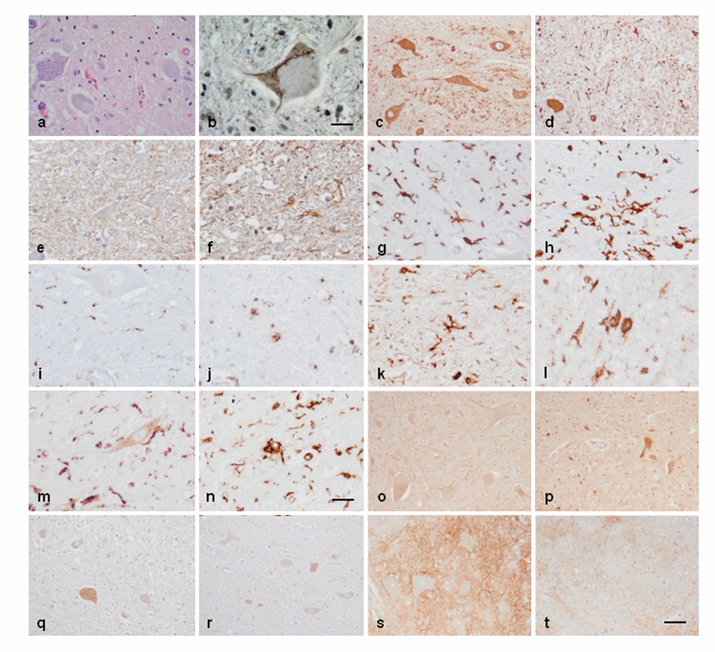 Anterior horn of the spinal cord. Haematoxilin and eosin staining showing damaged neurons in ALS (a). Immunohistochemistry to TDP-43 showing skein-like intracytoplasmic inclusions (b), VDAC (c, d), GFAP (e, f), IBA-1 (g, h), CD68 (i, j), HLA-DRB1 (k, l), HLA-DRB5 (m, n), IL-10 (o, p), TNF-α (q, r) and GluT (SLC1A2) (s, t) in the anterior horn of the lumbar spinal cord in control (c, e, g, I, k, m, o, q, s) and sALS (a, b, d, f, h, j, l, n, p, r, t) cases. TDP-43-immunoreactive cytoplasmic inclusions are seen in motor neurons in sALS. GFAP is increased in reactive astrocytes; microglial cells have a round, amoeboid morphology as seen with IBA-1, CD-68, HLA-DRB1, and HLA-DRB5 antibodies. VDAC immunoreactivity is decreased whereas IL-10 and TNF-α is increased in remaining motor neurons in sALS. SLC1A2 immunoreactivity is reduced in the membrane of neurons and in neuropil of the anterior horn in sALS. Paraffin sections, slightly counterstained with haematoxylin; a, c-d, o-t, bar in t = 40μm; e-n, bar in = 20μm; bar in b = 10μm.