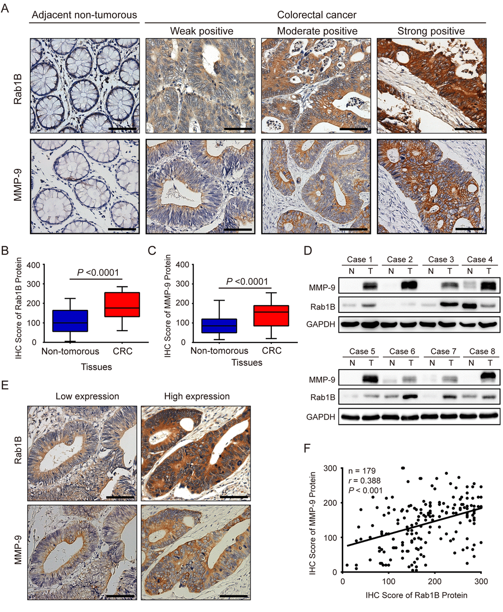 Rab1B and MMP9 expressions are significantly increased in colorectal cancer tissues. (A) Shown are representative immunohistochemistry (IHC) staining of Rab1B and MMP9 in CRC and adjacent non-tumor tissues. Scale bars represent 50 μm. (B) Comparison of Rab1B protein expressions between CRC tissues and matched adjacent non-tumorous tissues. (C) Comparison of MMP9 protein expressions between CRC tissues and matched adjacent non-tumorous tissues. (D) The expression levels of Rab1B and MMP9 proteins in eight pairs of CRC tissues (T) and adjacent non-tumorous tissues (N) are analyzed by immunoblot. (E) Concordance of Rab1B and MMP9 expressions in CRC. Consecutive CRC sections were analyzed for the expression of Rab1B and MMP9 by IHC. Shown are two representative cases. Scale bars represent 50 μm. (F) The correlation between Rab1B and MMP9 protein expressions in CRC tissues as evaluated by Spearman correlation analysis.