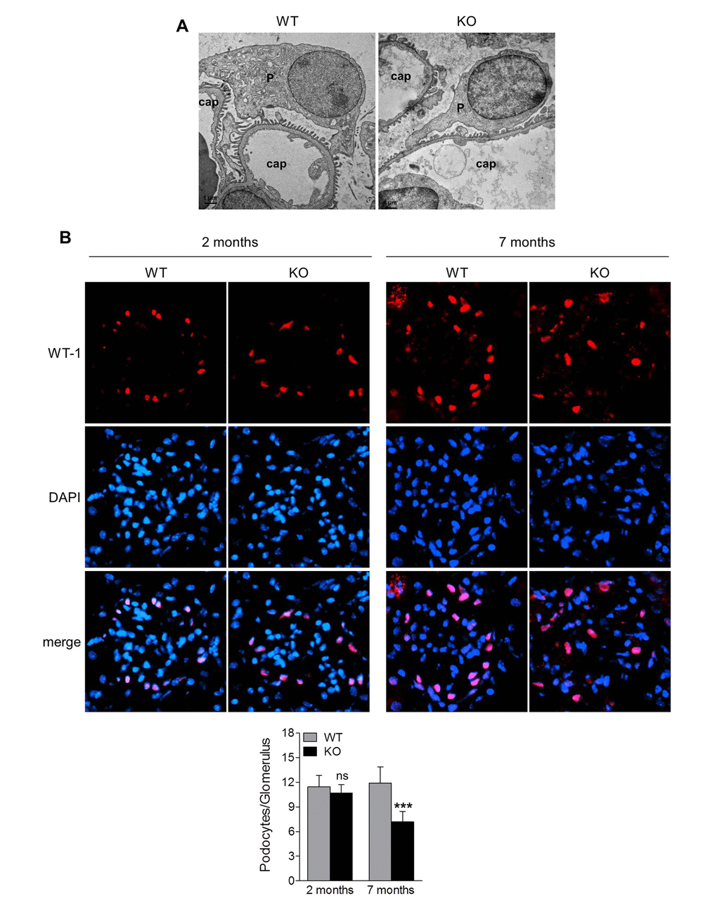 Sirt6 deletion results in podocyte foot process effacement and cellular loss. (A) Ultrastructural analysis of the kidneys from WT and Sirt6 KO mice at 2 months of age by transmission electronic microscopy. P: podocyte; cap: capillary. (B) Kidney cyrosections from WT and Sirt6 KO mice at 2 and 7 months of age were stained with antibody against podocyte marker WT-1 (red) and images were taken by fluorescence microscopy. Blue: DAPI staining for nucleus. Podocyte numbers were counted randomly in 15 glomeruli/section and quantified. Data are presented as mean ± SEM. ***p