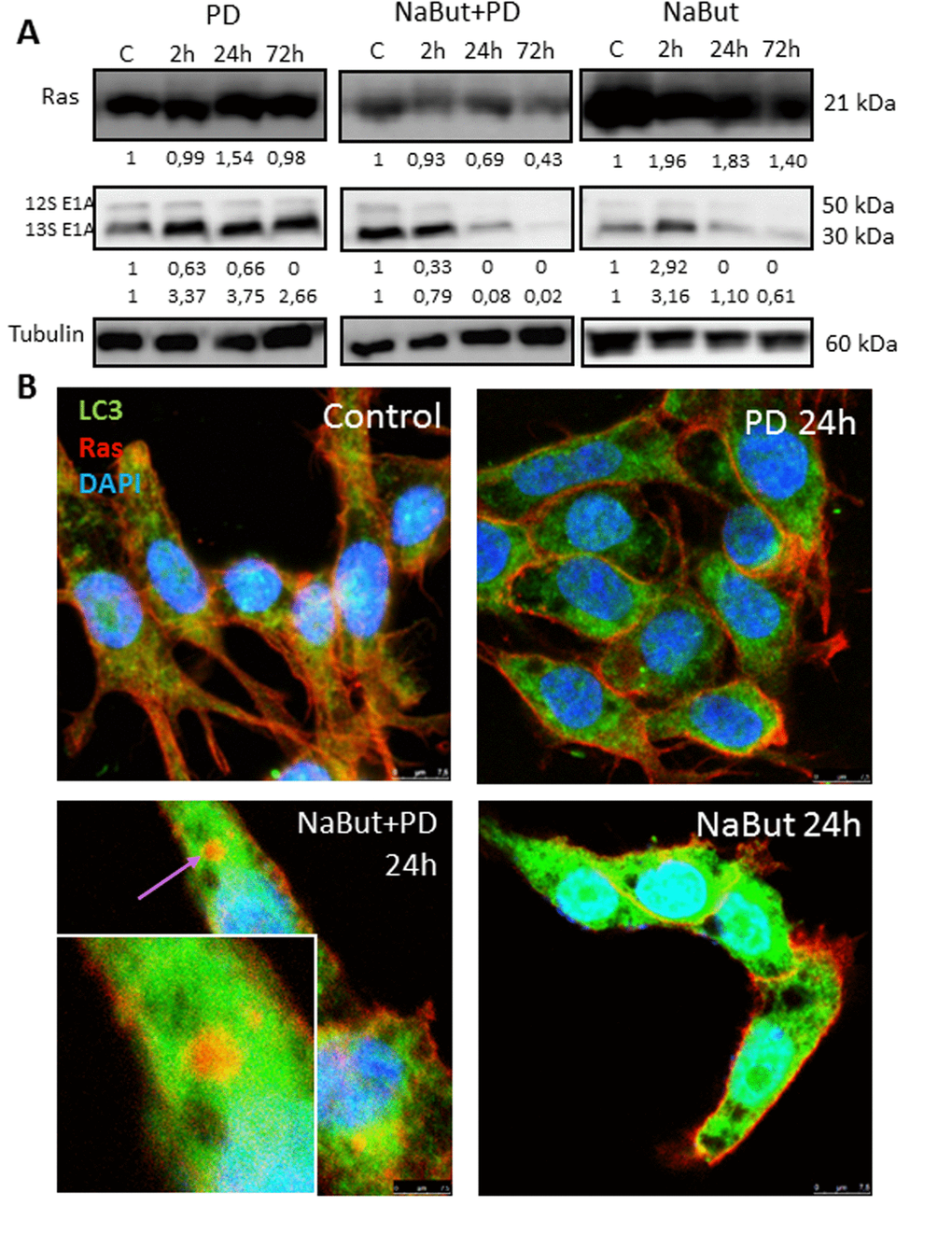 MEK/ERK suppression in senescent ERas cells changes balance of E1A and Ha-Ras oncoproteins and leads to relocalization of Ras from the plasma membrane into the cytoplasm. (A) Western-blotting analysis of Ras and E1A (12S, 13S) expression. Cells were exposed to inhibitors and processed to Western-blotting in 12% gel. Numbers below present densitometry of bands. (B) Immunofluorescent images show changes of Ras (red) and LC3 (green) localization in senescent cells with suppressed MEK/ERK. Cells were treated with inhibitors for the indicated time, then fixed and stained with antibodies against pan-Ras and pan-LC3. Square indicates a magnified region showing Ras in the cytoplasm colocalized with LC3 in senescent PD-treated cell. Nuclei stained with DAPI (blue). Scale bars: 25 µm.