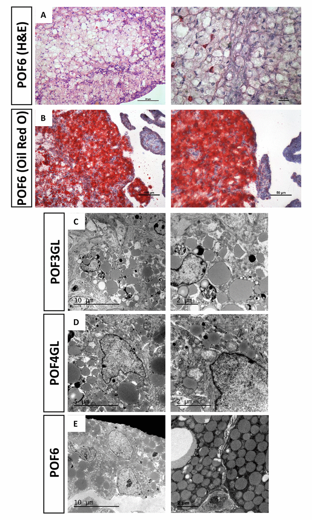 Steatosis-like morphology occurring in the granulosa cells from POFs. (A) HE staining was used to observe steatosis-like granulosa cells in POF6. Scale bars: 50 µm and 10 μm. (B) Oil Red O staining was used to verify lipid droplets existing in the coalescence of POF6. Scale bars: 100 µm and 50 µm. (C-E) TEM was used to observe the large quantity of lipid droplets existing in POF3, POF4 and POF6.