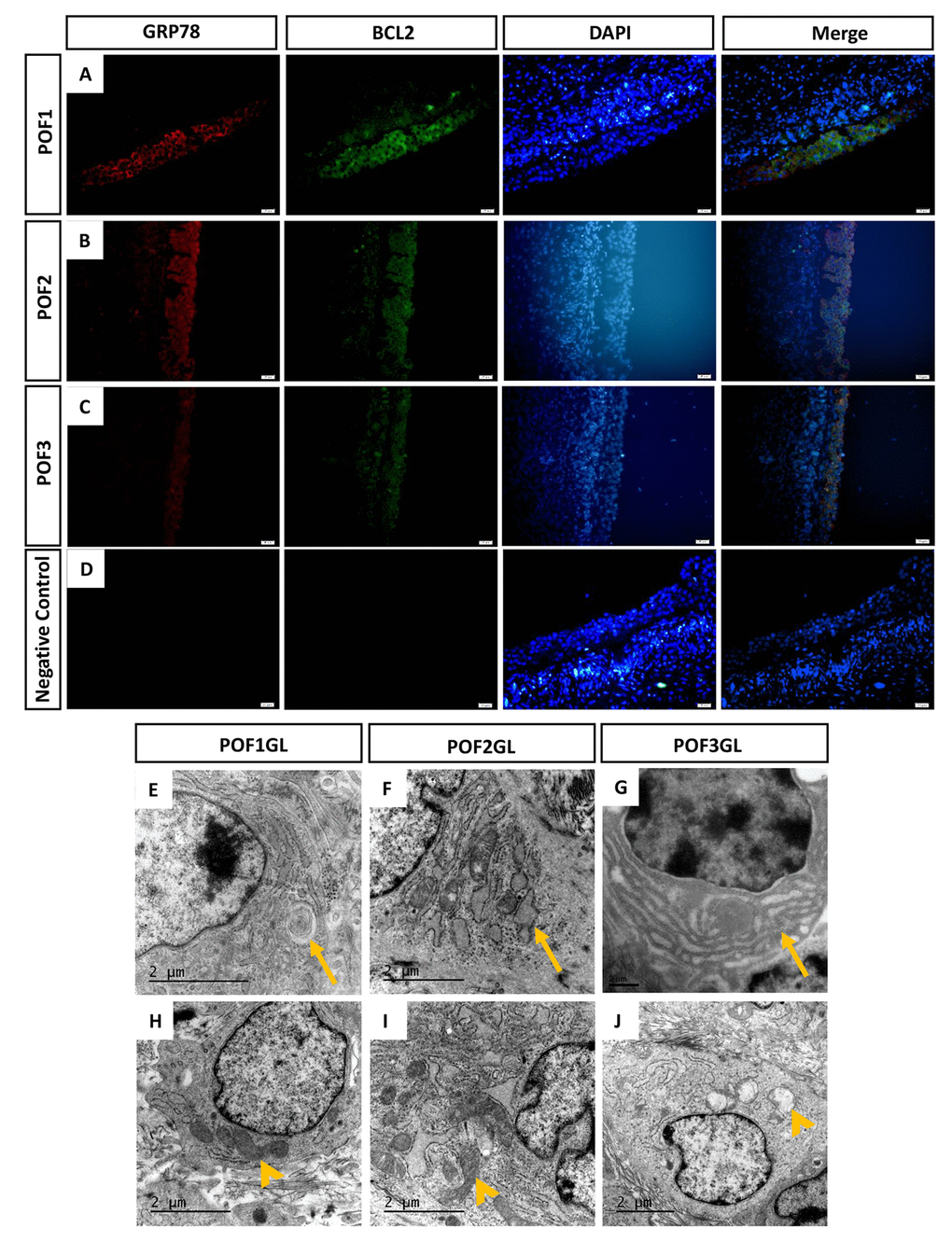 GRP78 and BCL2 co-expressed in the granulosa layer from POFs. (A-C) Histological sections of POFs (POF1 to POF3) were given immunofluorescent labels with ER stress marker GRP78 (Red) and mitochondria anti-apoptosis marker BCL2 (Green), showing the main distribution in the granulosa layer. Scale bar: 20 μm. (D) Negative Control. (E-F) TEM was used to observe ER lesions, concentric round, dilatation and vesiculation and hyperplasia, respectively (arrows). (H-J) TEM was used to observe normal mitochondria and vacuolated mitochondria, respectively (arrowheads). GL represents the granulosa layer.