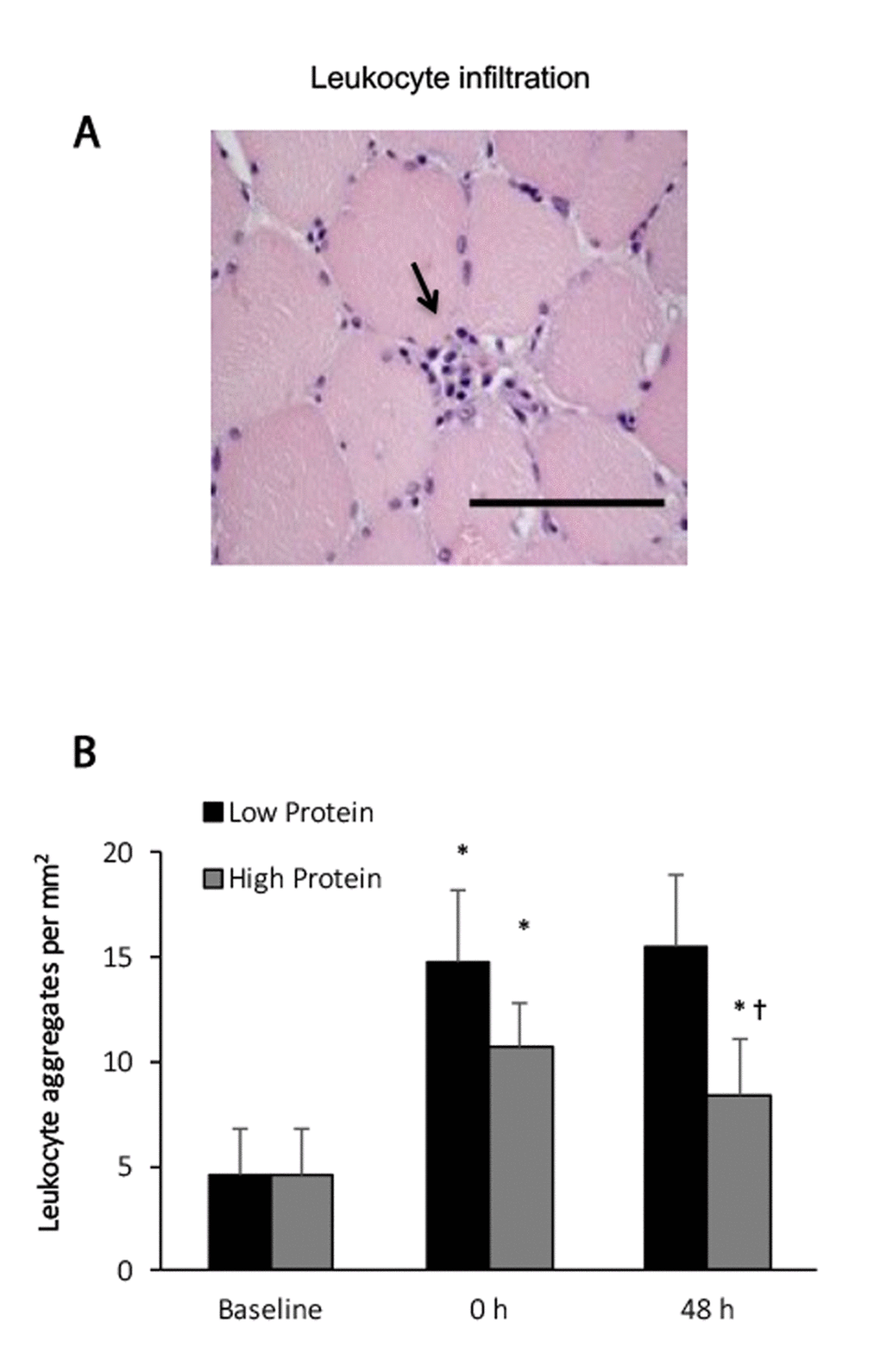 Leukocyte infiltration in human skeletal muscle after resistance exercise. (A) Representative hematoxylin and eosin staining of a muscle cross-section (leukocytes infiltration indicated by an arrow). (B) Resistance exercise immediately increased leukocyte infiltration into skeletal muscle. High protein supplementation before and after resistance exercise attenuated exercise-induced leukocyte infiltration. * Significant difference against Baseline, P 