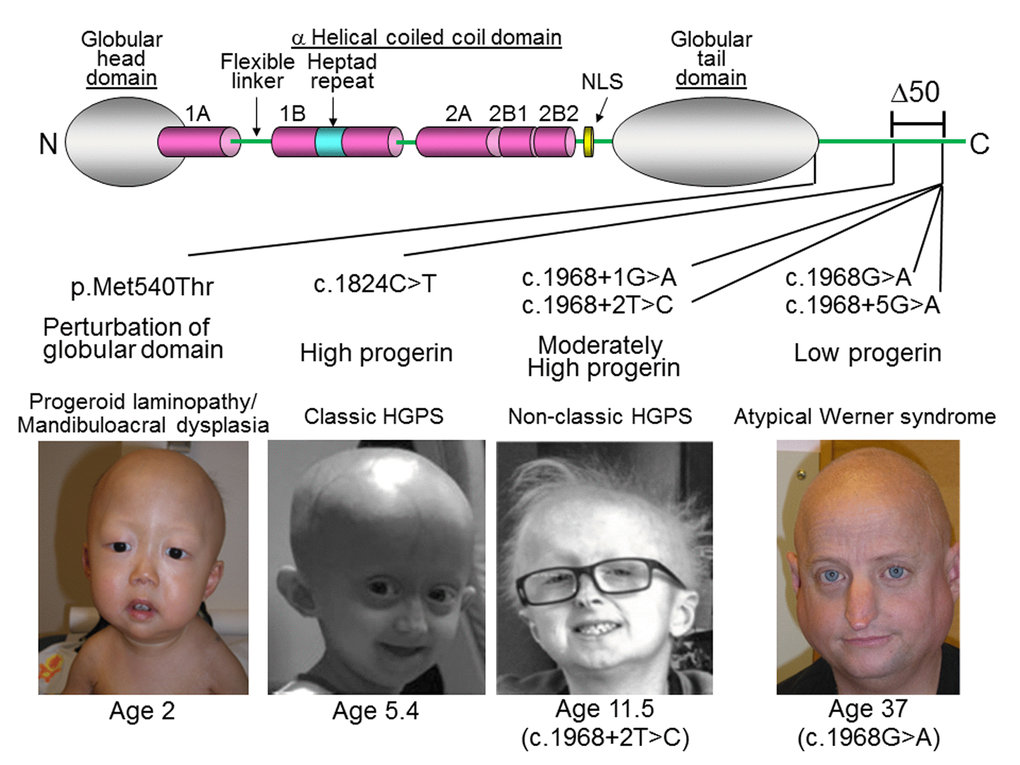 LMNA mutations in progeria patients. The diagram shows the structure of lamin A. It consists of globular head domain, linker regions, α-helical coiled coil domain and globular tail domain. Locations of the progeria LMNA mutations in this study were shown with molecular mechanism of mutant lamin A protein and clinical phenotype, as previously reported in [34] (p.Met540Thr) [29], (c.1824C>T) [30], (c.1968+1G>A) [31], (c.1968+2T>C), and [36] (c.2968G>A and c.1968+5G>A). Δ50 indicates the region of deletion in progerin, also present in ZMPSTE24 mutant progeria [32]. Photos were reproduced with permission.