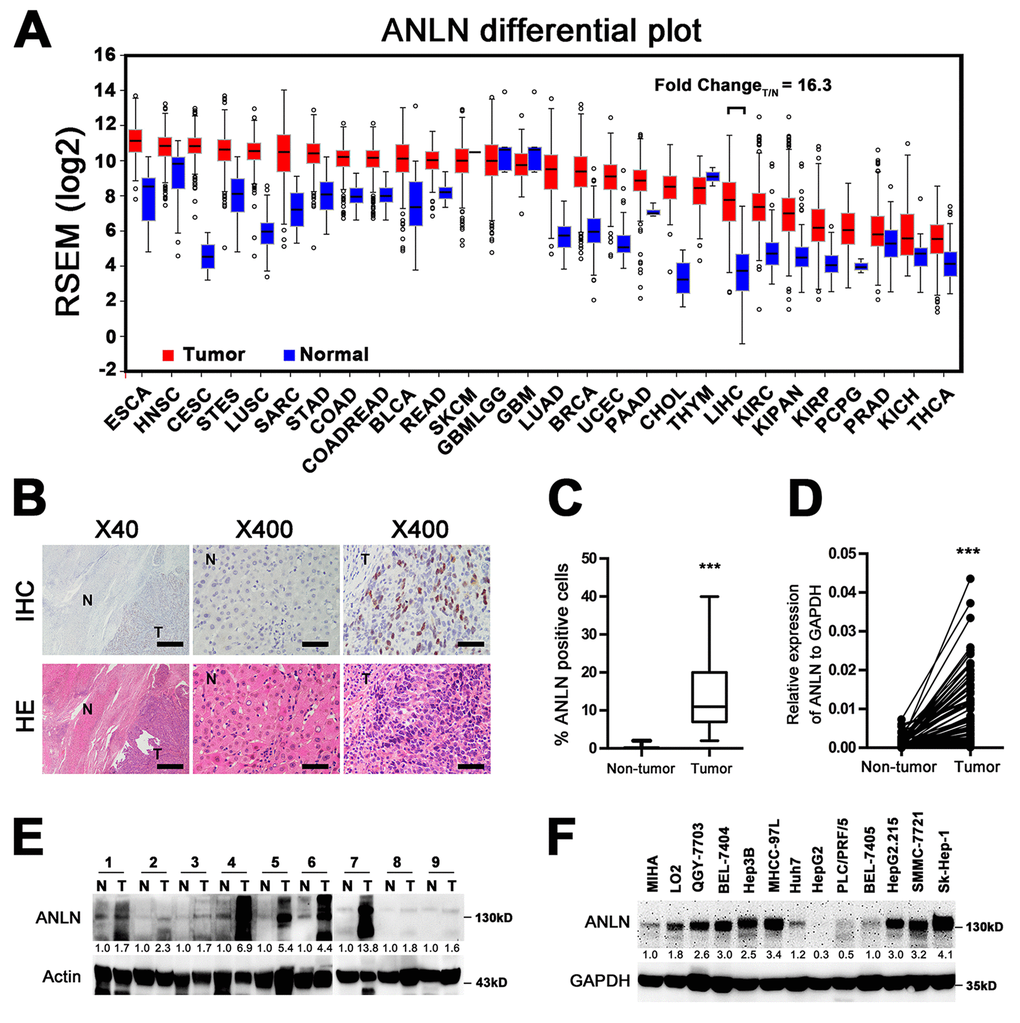 ANLN is highly expressed in hepatocellular carcinoma. (A) The mRNA levels of ANLN in global human cancer tissues (red) and non-tumor tissues (blue) were analyzed using the TCGA database (http://firebrowse.org/). Noticeably, the fold change of tumor vs normal tissue in hepatocellular carcinoma was 16.3. ESCA: Esophageal carcinoma; HNSC: Head and neck squamous cell carcinoma; CESC: Cervical squamous cell carcinoma and endocervical adenocarcinoma; STES: Stomach and esophageal carcinoma; LUSC: Lung squamous cell carcinoma; SARC: Sarcoma; STAD: Stomach adenocarcinoma; COAD: Colon adenocarcinoma; COADREAD: Colon and rectum adenocarcinoma; BLCA: Bladder urothelial carcinoma; READ: Rectum adenocarcinoma; SKCM: Skin Cutaneous melanoma; GBMLGG: Glioblastoma multiforme and brain lower grade glioma (GBM + LGG); GBM: Glioblastoma multiforme; LUAD: Lung adenocarcinoma; BRCA: Breast invasive carcinoma; UCEC: Uterine corpus endometrial carcinoma; PAAD: Pancreatic adenocarcinoma; CHOL: Cholangiocarcinoma; THYM: Tymoma; LIHC: Liver hepatocellular carcinoma; KIRC: Kidney renal clear cell carcinoma; KICH: Kidney chromophobe; KIRP: Kidney renal; KIPAN: Pan-kidney cohort (KICH + KIRC+ KIRP); PCPG: Pheochromocytoma and paraganglioma; PRAD: Prostate adenocarcinoma; THCA: Tyroid carcinoma. (B) Representative image of ANLN expression in HCC tissue and matched adjacent tissue by IHC and HE analyses. Scale bar for the left panel: 500 μm; Scale bar for the right panel: 50 μm. T: tumor; N: non-tumor. (C) Quantification of the percentage of ANLN-positive cells in tumor tissues and non-tumor tissues from 201 HCC slices. ***P D) The mRNA levels of ANLN from 81 pairs of HCC tissues and matched adjacent non-tumor tissues were tested by quantitative PCR. GAPDH was used as an internal control. ***P E) The protein levels of ANLN in 9 pairs of HCC tissues and matched non-tumor tissues were determined by western blotting assay. The relative fold changes of T compared with N are shown below. T: tumor; N: non-tumor. (F) ANLN expression in HCC cell lines. The relative fold changes of all cell lines compared with MIHA are shown below.