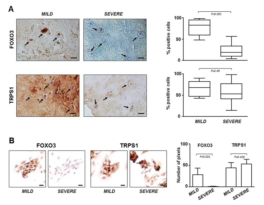 FOXO3 and TRPS1 expression in IVD tissues and P0 cells. (A) Immunohistochemistry on IVD tissues with MILD or SEVERE IDD and (B) immunocytochemistry on P0 cells demonstrating the presence of FOXO3 and TRPS1 (positive cells in representative optical photomicrographs are indicated with arrows). Protein levels were quantified by densitometric analysis of immunostaining using ImageJ software and expressed as % of positive cells per area (5 sections per sample; MILD group, n = 7; SEVERE group, n = 9). The results are reported as Whisker box plot representing min to max (line indicates median). For densitometric quantification of immunocytochemical pictures data were expressed as means of pixels per one hundred cells ±SD (MILD group, n = 7; SEVERE group, n = 9). Exact P-values are reported. Scale bars: 20 μm.