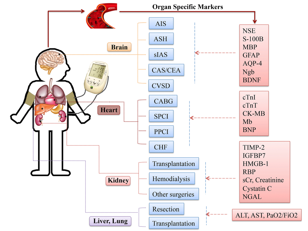 Specific circulating markers for different organ scenarios. Abbreviations: AIS, acute ischemic stroke; ASH, acute subarachnoid hemorrhage; sIAS, symptomatic intracranial arterial stenosis; CEA, carotid endarterectomy; CAS, carotid angioplasty and stenting; CVSD, cerebral small vessel disease; CABG, coronary artery bypass graft surgery; SPCI, selective percutaneous coronary intervention; PPCI, primary percutaneous coronary intervention; CHF, chronic heart failure; NSE, neuronal specific enolase; S-100B, S100 calcium binding protein B; GFAP, glial fibrillary acidic protein; AQP-4, aquaporin-4; Ngb, Neuroglobin; cTnI, cardiac troponin I; cTnT, cardiac troponin T; CK-MB, creatine kinase-myocardial band; Mb, myoglobin; BNP, brain natriuretic protein; TIMP-2, tissue inhibitor of metalloproteinases-2; IGFBP-7, insulin like growth factor-binding protein-7; HMGB-1, high-mobility group box protein-1; sCr, serum creatinine; NGAL, neutrophil gelatinase-associated lipocalin; ALT, alanine aminotransferase; AST, aspartate aminotransferase; PaO2/FiO2, partial pressure of oxygen/fraction of inspired oxygen.