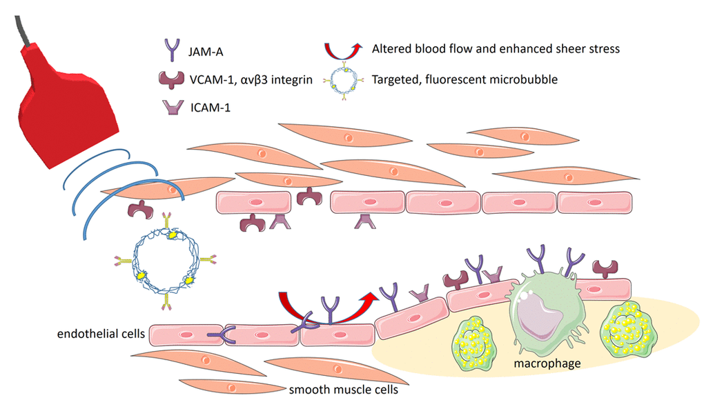 Scheme illustrating molecular ultrasound imaging with targeted, fluorescent, polymeric ultrasound microbubbles. While ICAM-1 served as a general target of vascular inflammation, VCAM-1 and αvβ3 faithfully enabled the assessment of major damages of the vascular wall and its regeneration. JAM-A particularly qualified as a very early marker of endothelial activation being translocated to the endothelial surface under altered vascular flow (Clip art was used from the Servier’s “Medical Art” database (http://www.servier.com/Powerpoint-image-bank) and modified).