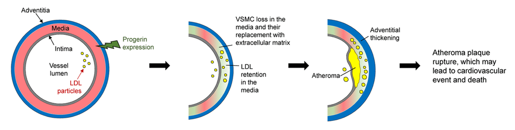 Proposed model of accelerated atherosclerosis induced by progerin expression in vascular smooth muscle cells (VSMCs). The aortic wall has three layers: the adventitia, media (containing VSMCs), and intima (containing endothelial cells). Progerin expression in VSMCs leads to their progressive loss in the aortic media and their replacement by extracellular matrix. These changes, together with other factors, increase low-density lipoprotein (LDL) retention in the aortic wall, which exacerbates atheroma plaque formation. In parallel, the adventitia becomes thicker and denser. Depletion of VSMCs in the atheroma may cause plaque instability and rupture, which ultimately provokes ischemic cardiovascular events (e.g. myocardial infarction) and premature death.