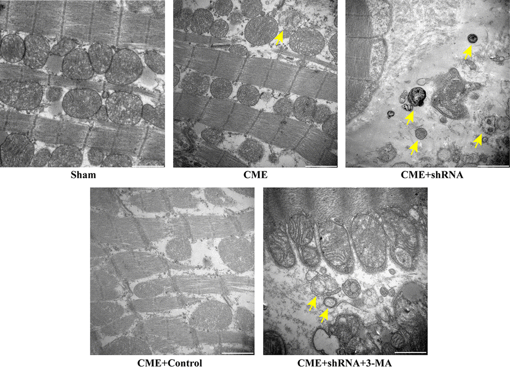 Inhibition of Egr-1 restored myocardial autophagy following CME. Image of autophagic vacuoles in the myocardium captured using a transmission electron microscopy. The arrow indicates typical autophagic vacuoles (x30,000, Scale bar = 1 μm).