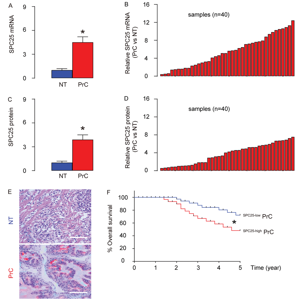 PrC with high SPC25 expression is associated with poor overall survival. (A-B) RT-qPCR for SPC25 mRNA levels in 40 PrC specimens and paired normal prostate tissue (NT), shown by mean ± SD (A), and by individual values (B). (C-D) ELISA for SPC25 protein levels in 40 PrC specimens and NT, shown by mean ± SD (C), and by individual values (D). (E) Immunostaining for SPC25 (fast red) in PrC and NT. (F) The 40 patients were followed-up for 5 years. The patients were classified into SPC25-high group (n=20) and SPC25-low group (n=20), based on the median value. Kaplan-Meier curves were plotted. *p