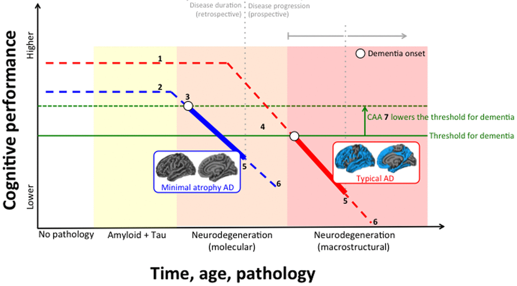 Hypothetical interrelation between subtypes of Alzheimer’s disease (AD), neurodegeneration, cerebral amyloid angiopathy (CAA), and cognitive reserve. (1) Higher cognitive reserve; (2) Lower cognitive reserve; (3) Earlier disease onset in minimal atrophy AD (disease onset in the figure refers to first symptoms of dementia, not to first evidence for biomarker abnormality); (4) Later disease onset in typical AD; (5) Similar disease duration at baseline (retrospective) between typical and minimal atrophy AD, and similar cognitive performance at baseline, with typical AD usually showing slightly more impairment; (6) Faster disease progression (prospective) with typical AD reaching severe dementia in shorter time; (7) CAA is more frequent in minimal atrophy AD and may lower the threshold for the amount of AD pathology needed to produce dementia.