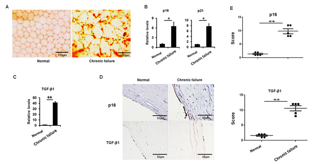 Increased senescence associated markers and TGF-β1 in the human corneal buttons CE with chronic graft rejection. (A) Clinical evaluation of corneal endothelial cells with chronic failure using alizarin red staining. (B-C) The mRNA expression of p16, p21 (B) and TGF-β1 (C) in the CE with or without chronic graft failure (**PPD-E) Representative photographs (D) and histopathology scores (E) for the IHC staining of p16 and TGF-β1 in the CE with chronic failure.