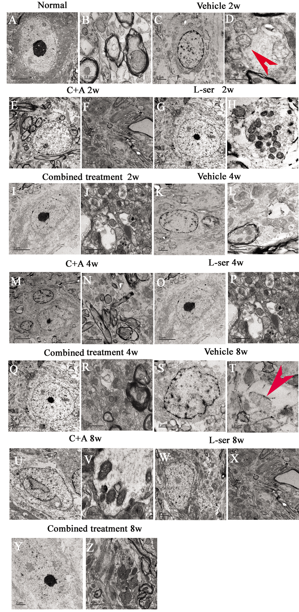 Representative electron micrographs showing mitochondrial atrophy, fragmented vacuoles, loose and fused alterations of the myelin sheath, and apoptotic features of the nuclei of spinal cord anterior horn motor neurons in the vehicle-treated model rats, as well as the attenuating effects of treatment with C16+Ang-1, L-serine, or both. (A–B) Rats in the control group showed (A) normal neuronal nuclei with uncondensed chromatin and (B) normal myelinated axons with dark, ring-shaped myelin sheaths surrounding the axons, with normal shaped mitochondria. (C-D, K-L, S-T) In vehicle-treated model rats 2–8 weeks after L-BMAA injection, fragmented vacuoles and loose and fused alterations on the myelin sheath were found, as well as mitochondrial malformations such as vacuolization and swollen cristae (arrows in D). At 8 weeks after L-BMAA injection (T), some mitochondria had a completely atrophied appearance, and their cristae had vanished. More drastic alterations in demyelination and axonal loss were found (L, T), and neurons also showed apoptotic features with a contracted nucleus and condensed, fragmented, and marginated nuclear chromatin (C, K, S). By contrast, in rats treated with C16+Ang-1(E-F, M-N, U-V), L-serine (G-H, O-P, W-X), and both (I-J, Q-R, Y-Z), newly formed myelin sheaths were observed surrounding the intact axons, and the morphology of mitochondria and nuclei were relatively normal. This was particularly obvious in the group that received the combined treatment (Y, Z). (B, H, T, V) Scale bar = 500 nm; (D, J, L, P, R, Z) scale bar = 1 μm; (C, E, F, K, N, S, U, W, X, Y) scale bar = 2 μm; (A, G, I, M, O, Q) scale bar = 5 μm.
