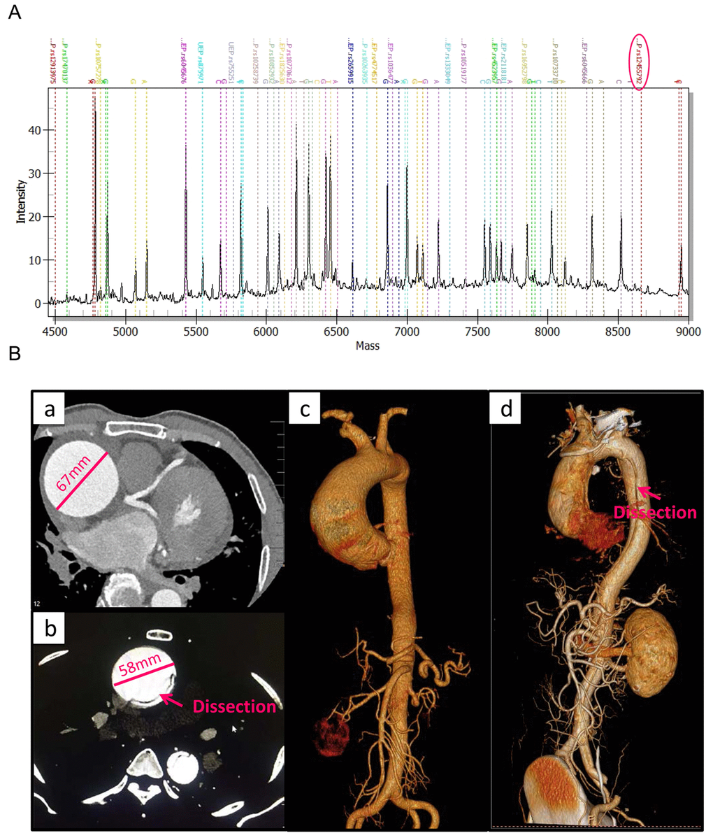 The MALDI-TOF MS spectrum of candidate SNPs and large vessels CT angiography for clinical features of TAAD patients. (A) The MALDI-TOF MS spectrum of candidate SNPs. Genotypes of SNPs are determined by plotting peak intensity (y-axis) against mass (Da) (x-axis). The spectrum of rs12455792 is indicated by a circle. (B) Large vessels CT angiography and 3D scanning images for clinical features of thoracic aortic aneurysm (a, c) and dissection (b, d) patients.