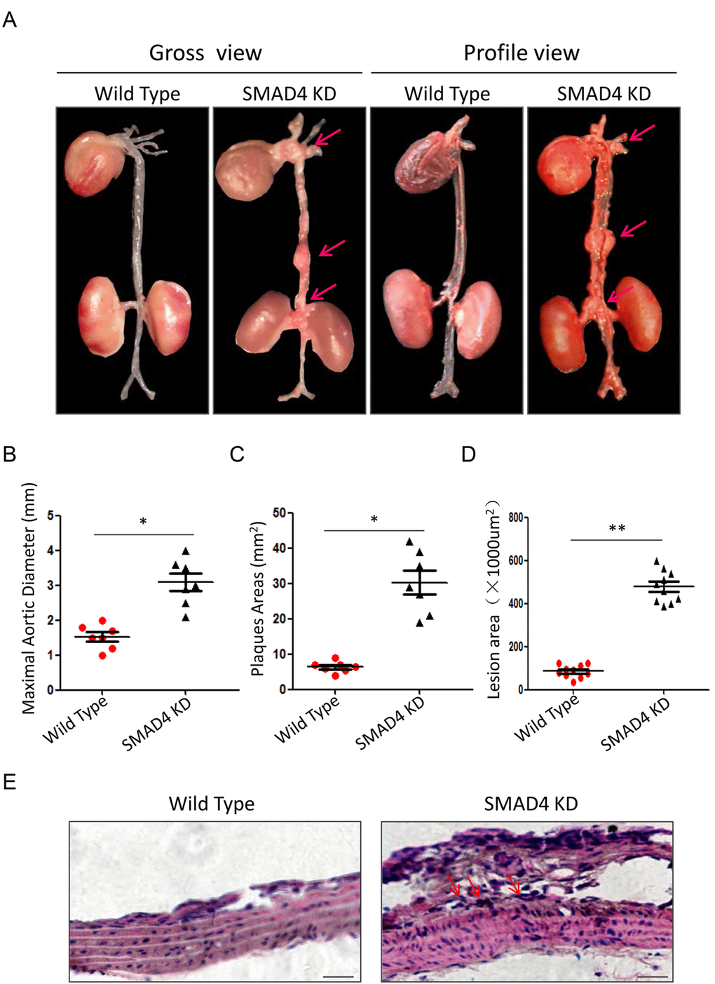 Repression of SMAD4 promotes the formation of TAAD. (A) The gross view and profile view of aortas from Wild Type and SMAD4 KD mouse models. Quantitative analysis of maximal aortic diameter (B), plaques area (C) and lesion area (D) between different groups, n=5/group; (E) Representative graphs of HE staining for thoracic aortas from Wild Type and SMAD4 KD mouse models. Data are means ± SD. *PP