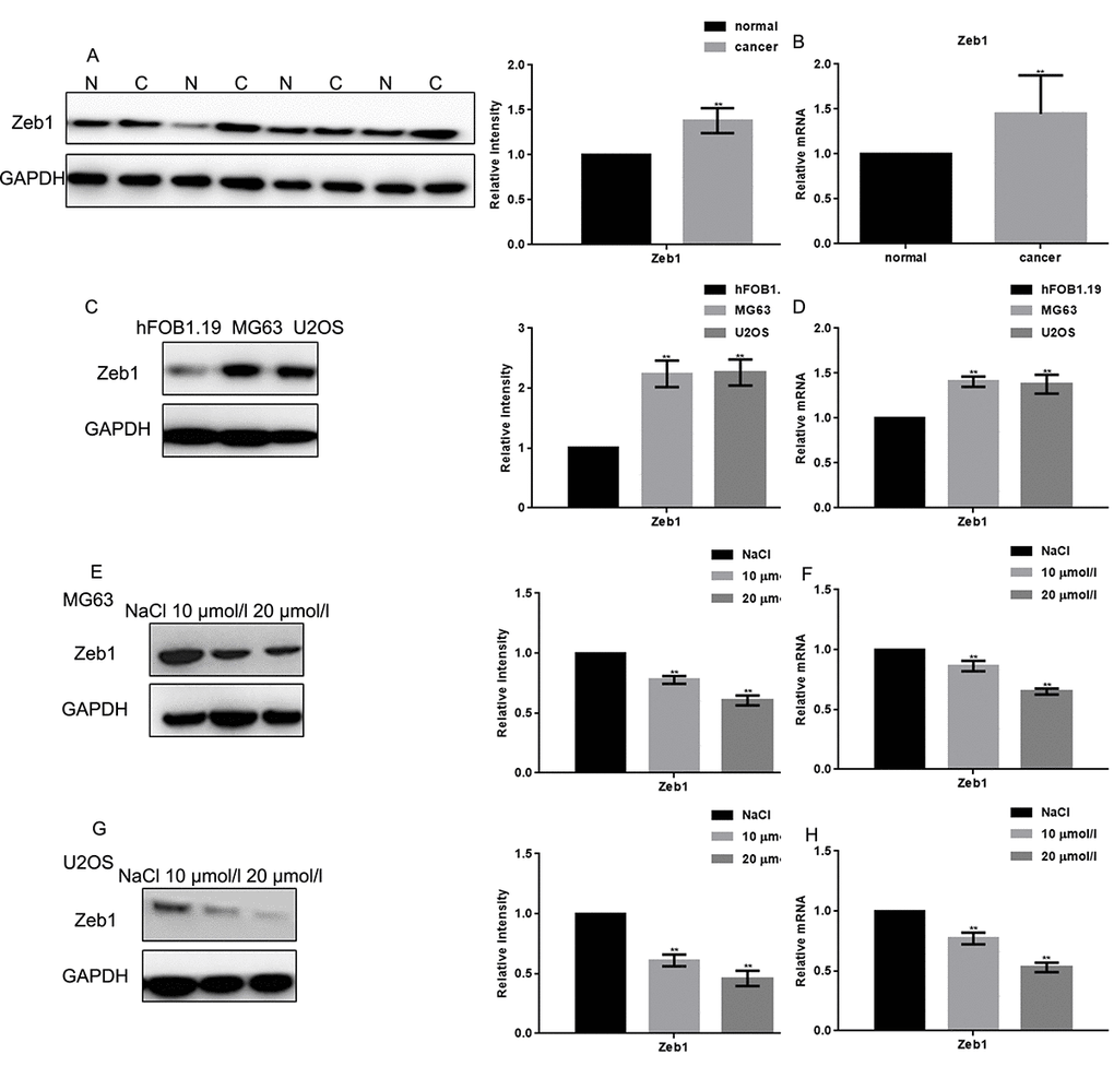Naringin inhibits the expression of Zeb1 in osteosarcoma cells. (A, B) Zeb1 expression in 30 human osteosarcoma specimens and their adjacent normal tissue counterparts was detected by Western blot and real-time PCR. **P C, D) Zeb1 expression in MG63, U2OS and hFOB1.19 cells, detected by Western blot and real-time PCR. **P E-H) Zeb1 expression detected by Western blot and real-time PCR in MG63 and U2OS cells treated with NaCl or indicated concentrations of naringin for 24 h. **P 