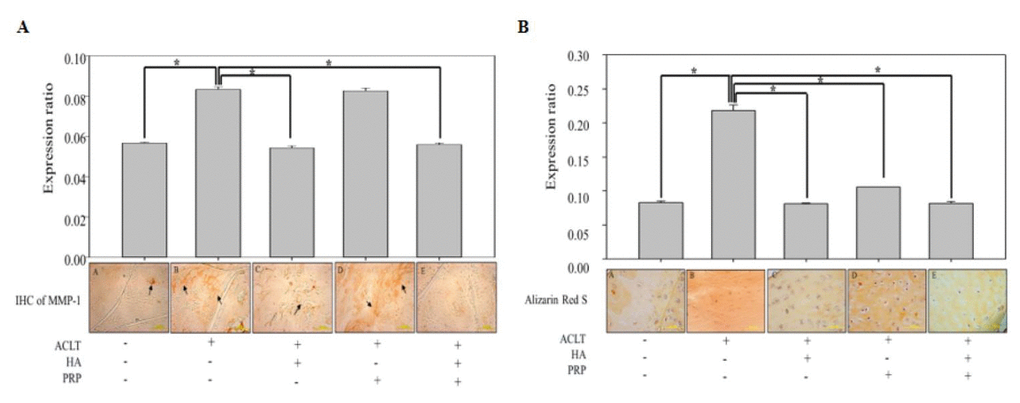 In vivo anti-inflammatory and anti-hypertrophic efficacy of HA+PRP in ACLT-OA knee joint. (A) Immunohistochemical (IHC) staining for matrix metalloproteinase (MMP-1) distributions (indicated by black arrows) and their relative quantification in ACLT, HA, PRP and HA+PRP treated groups (B) Alizarin Red S staining and their relative quantification for detection of calcium depositions (red color), indicating chondrocyte hypertrophy in ACLT, HA, PRP and HA+PRP treated groups. *p