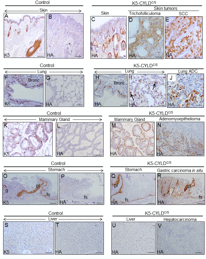 Analysis of the expression of the transgene in the tumors developed in the K5-CYLDC/S mice and in their matched non tumoral tissue. Immunohistochemical staining with K5 and HA antibodies. (A, B) Snout sections from Control mice. K5 expression in the basal layer of the epidermis, HF and the immature cells of the sebaceous glands (A); HA is not detected (B). (C) HA expression in the snout of transgenic mice following the K5 expression pattern. HA expression in the tricofolliculoma of the snout (D) and in the SCC of the back skin of K5-CYLDC/S mice (E). (F-G) K5 expression in the basal layer of the epithelium of bronchia and bronchioles of Control mice (F); no HA staining was observed (G). (H, I) HA in bronchia and bronchioles of transgenic mice (H) and in alveolar cells (I). (J) HA expression in the lung ADC. (K, L) K5 expression in the myoepithelial cells around the mammary secretory acini of Control mice (K); HA is not detected (L). (M) HA in the mammary secretory acini of lactating transgenic mice following the K5 expression patter. (N) HA expression in the mammary adenomyoepithelioma. (O, P) Stomach from a Control mice showing K5 expression in the aglandular epithelia (forestomach, fs), plica (pl), and in scattered glands (g) (O); HA is not expressed (P). (Q) Expression of HA in the stomach of transgenic mice following the K5 expression pattern. (R) Gastric carcinoma in situ expressing HA. (S, T) Neither K5 nor HA are expressed in the liver of Control mice. (U) HA is not detected in hepatocytes of K5-CYLDC/S mice. (V) HA is not expressed in the hepatocarcinomas (HCC) of transgenic animals. Scale bars: 300 μm (A-C; N, R); 150 μm (D, E, I, J); 70 μm (K-M); 250 μm (G, O, P); 200 μm (F, H, Q, V); 100 μm (S-U). ADC: adenocarcinoma.