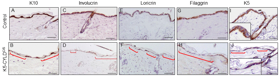 Deficient differentiation in the skin of K5-CYLDC/S mice. Representative immunostainings of the back skin of 20-month-old mice (A-J). Observe the strong expression of the epidermal differentiation proteins Involucrin, Loricrin and Filaggrin in the suprabasal layers of the epidermis of Control mice (A,C,E,G); and the weak and discontinuous expression of these proteins in the epidermis of K5-CYLDC/S mice (B,D,F,H), specially faint in the areas of epidermal atrophy (red brackets). (I, J) Representative images corresponding to the immunostaining of the back skin of Control (I) and transgenic (J) mice with the K5 specific antibody. (I) Strong K5 staining in basal keratinocytes of Control mice. A faint and patched expression is detected in the epidermis of the transgenic mice, especially in the regions of atrophic epidermis (indicated by red brackets). Scale bars: 180 μm (A-H); 150 μm (I, J).
