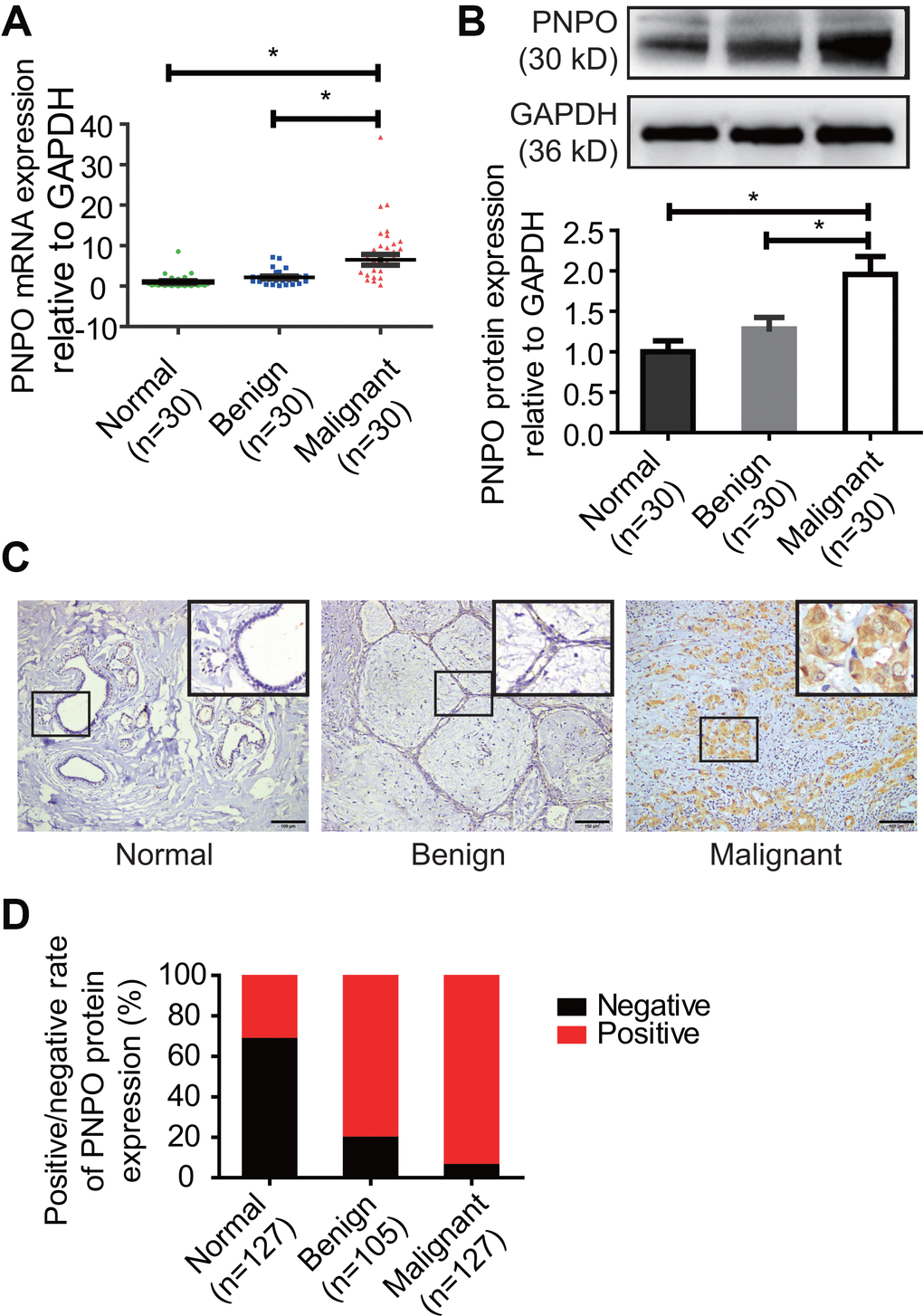 PNPO expression in human breast tissues. (A) PNPO mRNA expression was detected in breast tissues by qRT-PCR. (B) PNPO protein expression was detected in breast tissues by Western blot. Representative images and semi-quantitative analysis of the relative PNPO protein expression are shown in the upper and lower panel, respectively. (C) PNPO protein expression was detected in paraffin-embedded breast tissues by IHC. A picture in a frame is amplified. Brown color in a cell is considered positive staining. Original magnification, x200. Scale bar, 100 μm. (D) Quantified data of IHC. Normal, adjacent normal breast tissue; Benign, breast benign tumor (fibroadenomas); Malignant, breast malignant tumor (invasive ductal carcinoma); Negative, negative staining; positive, positive staining; n, number of cases. * P 