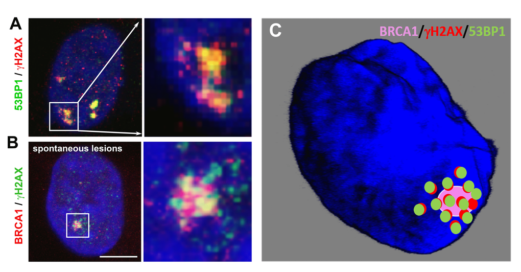 (A) Nuclear arrangement of the 53BP1 (green) protein and γH2AX (red) in spontaneously occurring DNA lesions. (B) The nuclear distribution pattern of the BRCA1 protein (red) and γH2AX (green) in spontaneous DNA lesions. HeLa cells were used for these illustrations, which depict the primary results published by [67] and [20]. Scale bars, 10 µm. (C) A pictorial illustration of BRCA1/γH2AX/53BP1 compartmentalization at a spontaneous DSB site: Chapman et al. [67] showed a spatial link between 53BP1- and BRCA1-positive foci or 53BP1- and γH2AX-positive repair foci. Suchánková et al. [20] described the methodology of immunostaining and showed a degree of colocalization between 53BP1-γH2AX, 53BP1-MDC1, and MDC1-γH2AX.