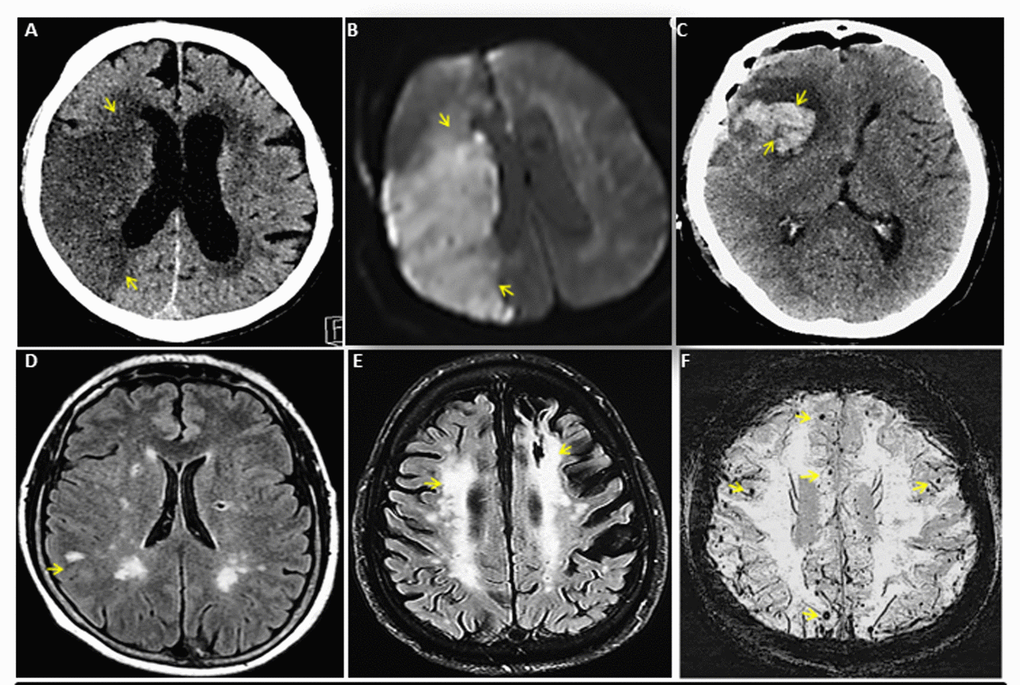 Spectrum of cerebrovascular diseases. (A) CT head without contrast of a 74 year old man with right middle cerebral artery (MCA) ischemic stroke. (B) Re-demonstration of acute right MCA ischemic stroke by MR brain of panel A patient. (C) CT head without contrast of a 75 year old woman with acute right frontal intracerebral hemorrhage with surrounding edema. (D) MR brain of a 54 year old woman with multiple chronic lacunar infarcts. (E) MR brain of an 80 year old man with white matter hyper-intensity representing severe microvascular disease. (F) A 73 year old woman with numerous cerebral microbleeds, few of these were shown with arrows. Source of images: These are original CT and MR images of patients collected by Mayo Clinic academics for education purpose and do not contain any patient identifier and material that has not been submitted or published elsewhere.