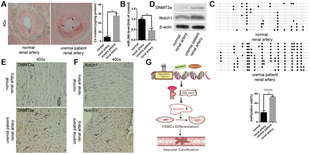 The function of miR-34b in patients with uraemia. (A) Alizarin Red S staining showed normal renal arteries from healthy donors and calcified renal arteries from uraemia patients. n = 5. Representative images were shown. The arrows indicate the calcification sites of the human renal artery. (B) qRT-PCR detected the expression of miR-34b in arteries from healthy donors and uraemia patients, respectively. (C) The methylation rate of CpG sites of miR-34 DNA in arteries from uraemia patients was significantly higher than that from normal donors. n = 3. Representative images were shown. (D–F) The levels of DNMT3a and Notch1 were determined by western blot and immunohistochemistry staining analysis in arteries from healthy donors and uraemia patients. (G) The proposed model of miR-34b regulating the process of vascular calcification. The data were expressed as mean ± SD, *p 