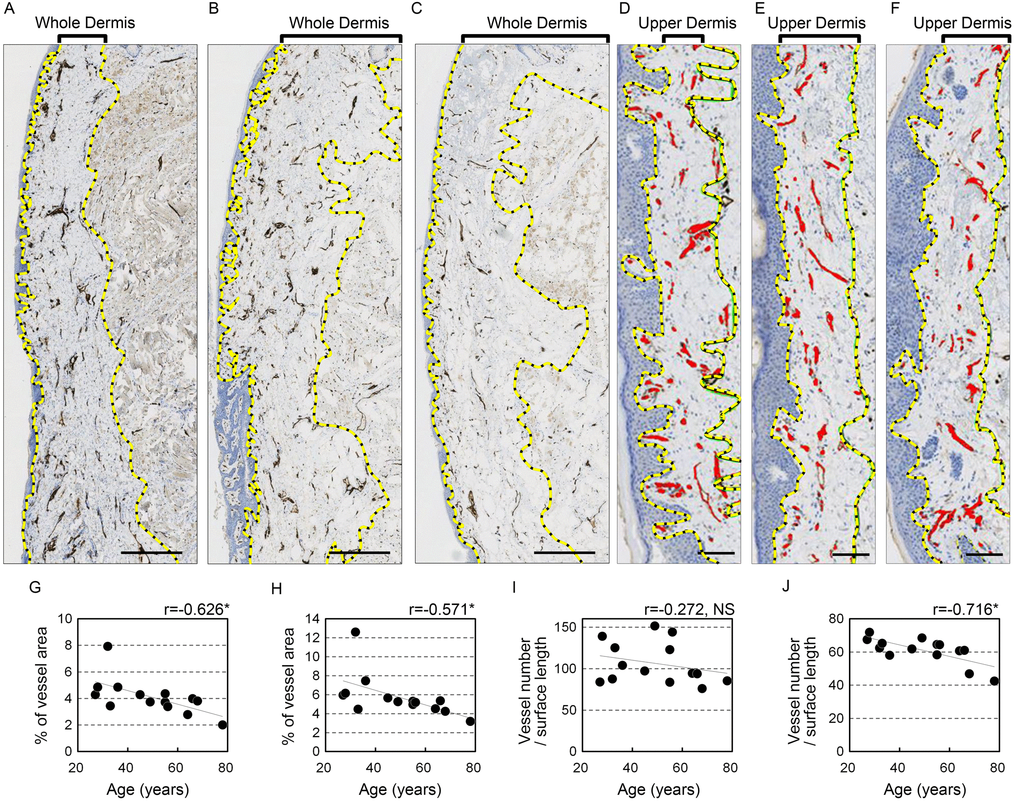 Blood vessels in the upper lip vermilion dermis decrease with age. Vessels are stained for anti-CD31. (A-F) Representative image staining: brown, CD31+ vessels; blue, cell nuclei. (A-C) Images of the whole vermilion dermis. Donors were 28 (A), 49 (B) and 64 (C) years old. Bar=500 μm. The yellow dotted line marks the boundary line of the whole dermis. (D-F) Images of the upper dermis of the vermilion. Donors were 27 (D), 45 (E), and 68 (F) years old. Bar=100 μm; red, blood vessels in upper dermis of the vermilion; yellow dotted line, boundary for the upper dermis. (G-K) Individual plots of vessel parameters shown according to age. (G, H) Age plotted against percentage of blood vessel area in the analyzed area. (I, J) Age plotted against the number of blood vessels per surface length (mm). (G, I) Whole vermilion dermis. (H, J) Upper dermis of the vermilion. n=14. *p