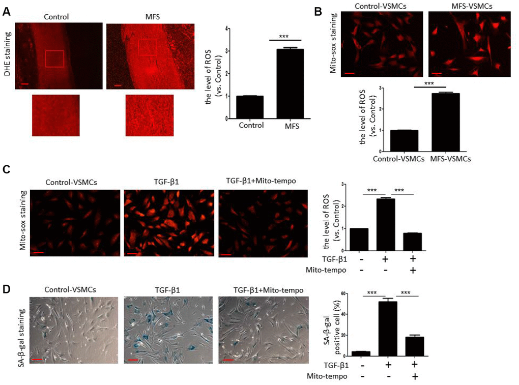 TGF-β1 induces cellular senescence in VSMCs through elevation of ROS. (A) Representative images and quantitative analysis of DHE staining in the ascending aorta of control donors and MFS patients. ROS levels were analyzed and expressed relative to control. Scale bar=200 μm. n=6. (B) Representative images and quantitative analysis of Mito-sox staining of control- and MFS-VSMCs. ROS levels were analyzed and expressed relative to control. n=3. Scale bar=100 μm. (C) Representative images and quantitative analysis of Mito-sox staining in control-VSMCs left untreated or treated with TGF-β1 or TGF-β1 combined with Mito-tempo. ROS levels was analyzed and expressed relative to control. n=3. Scale bar=100 μm. (D) Representative images and quantitative analysis of SA-β-gal staining in control-VSMCs left untreated or treated with TGF-β1 or TGF-β1 combined with Mito-tempo. n=3. Scale bar=100 μm. Numbers of SA-β-gal-positive cells are expressed as percentages of the total cells. Data are expressed as the mean±SEM. ***p