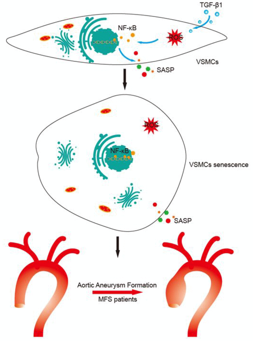 Proposed mechanisms for TGF-β1-induced VSMC senescence. This study shows that TGF-β1 induces VSMC senescence through activation of ROS/NF-κB signaling, which leads to aortic aneurysm formation in MFS patients.
