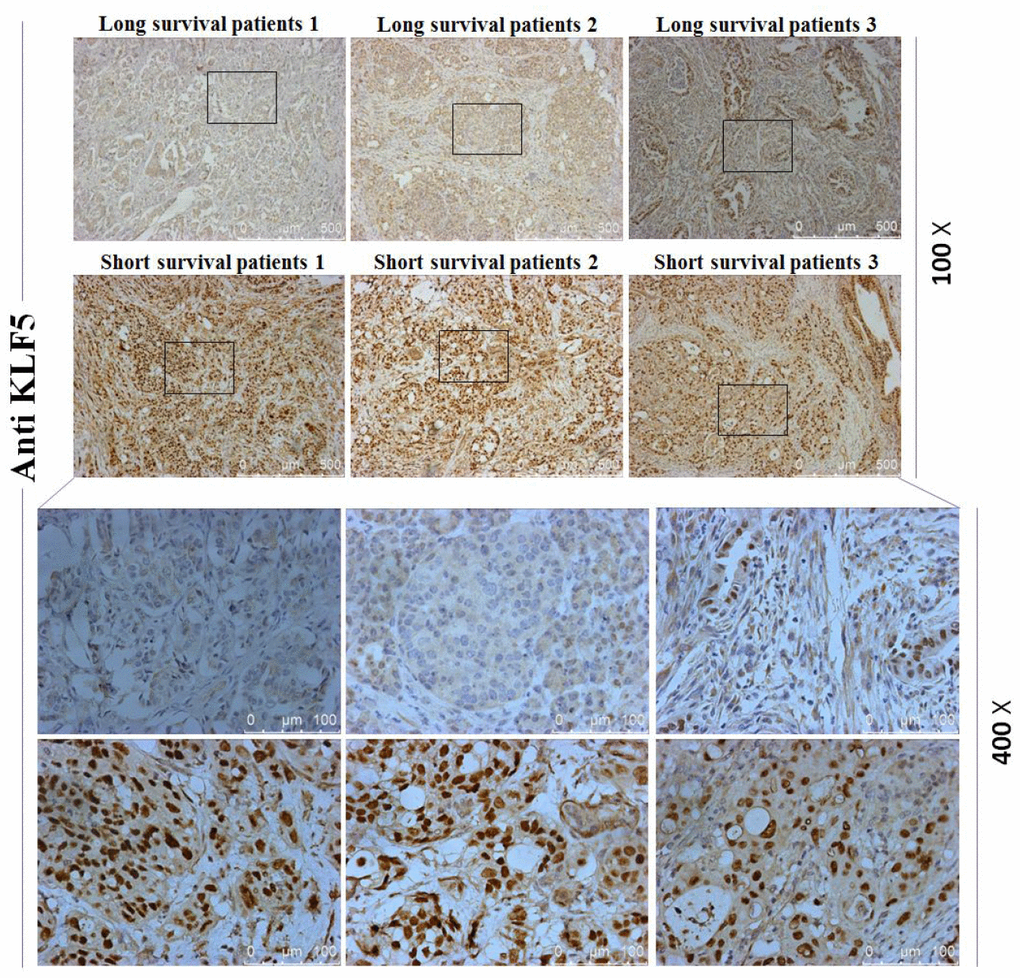 Immunohistochemical staining for KLF5. Staining for KLF5 is stronger in three short-surviving patients than in three long-surviving patients.