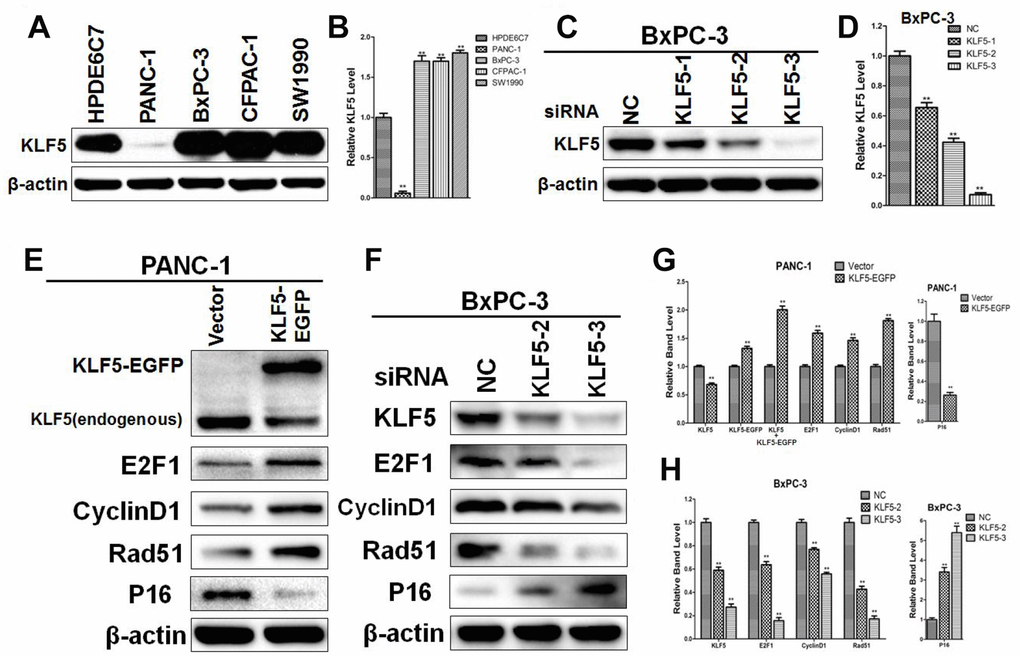 Western blot analysis confirming the regulatory relationships between KLF5 and its target genes (A) KLF5 expression in pancreatic cancer cell lines and a normal pancreatic cell line. (B) The density of each band was measured and normalized to the β-actin band. * P P C) KLF5 expression after transfection of cell with KLF5 siRNA. (D) The density of each band was measured and normalized to the β-actin band. * P P E) PANC-1 cells were transfected for 48 h with empty vector or KLF5-EGFP plasmid, after which the protein extracts were assayed by western blotting. β-actin was used as a protein loading control. (F) BxPC-3 cells were transfected for 48 h with negative control siRNA, siKLF5-2 or siKLF5-3, after which the protein extracts were assayed by western blotting. β-actin was used as a protein loading control. (G) The density of each band was measured and normalized to the β-actin band. * P P H) The density of each band was measured and normalized to the β-actin band. * P P 