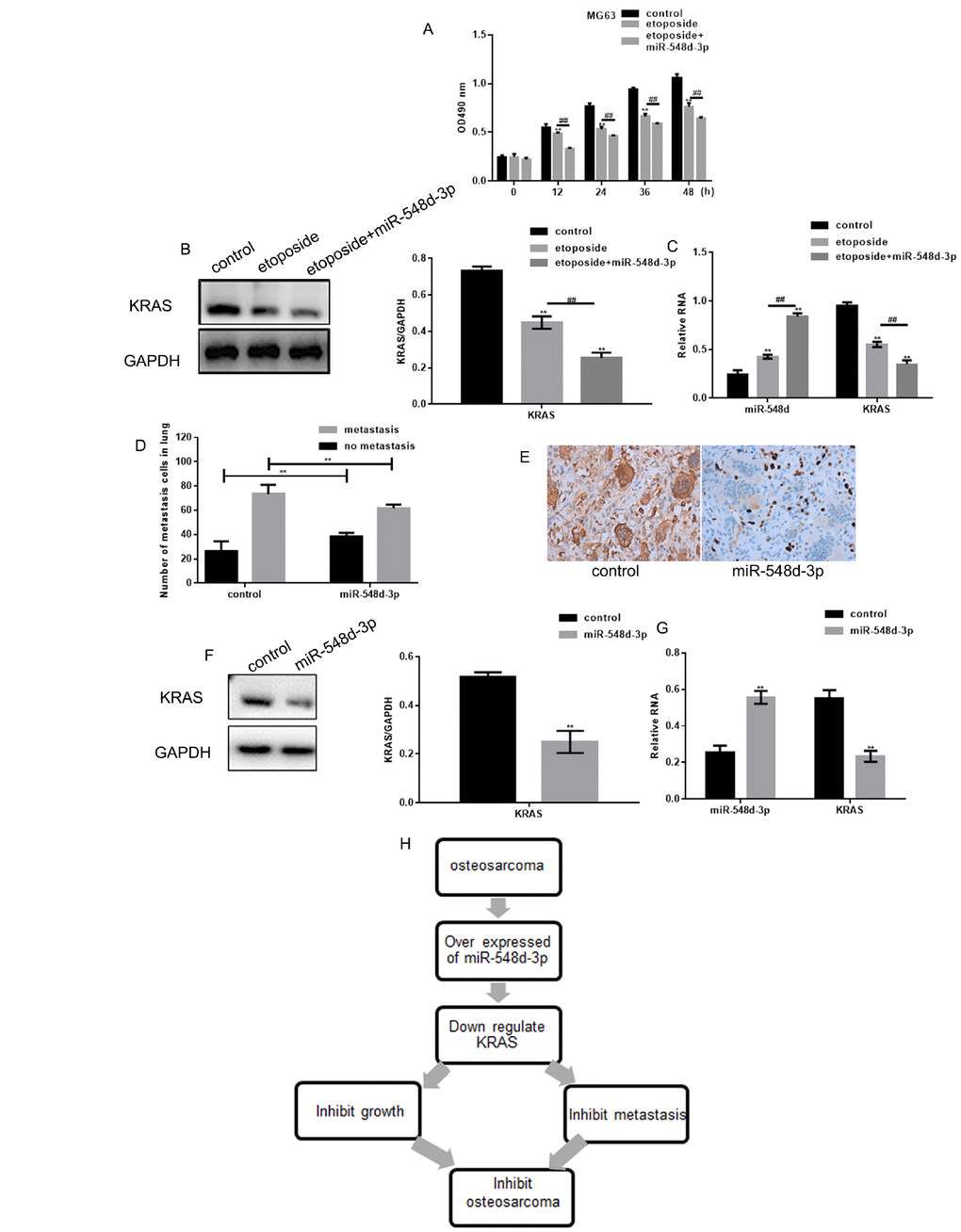 MiR-548d-3p inhibits osteosarcoma. (A) MG63 cell growth was measured with an MTT assay after treatment with control miRNA, 10 μM etoposide combined with control miRNA, or 10 μM etoposide combined with miR-548d-3p mimics. The results represent the mean±SD of three independent experiments. **P P B, C) MG63 cells were treated with control miRNA, 10 μM etoposide combined with control miRNA, or 10 μM etoposide combined with miR-548d-3p mimics. The protein and mRNA levels of KRAS were then measured by Western blotting and real-time PCR, respectively. **P P D) The migration of osteosarcoma cells to the lungs in mice treated with miR-548d-3p agomirs or control miRNA. The results represent the mean±SD. **P E) Immunohistochemical staining revealed the expression of KRAS in osteosarcoma in the control group and the miR-548d-3p overexpression group. (F, G) The protein and mRNA levels of KRAS were measured in MG63 cells by Western blotting and real-time PCR, respectively. The results represent the mean±SD of three independent experiments. **P H) The mechanism proposed in this article.