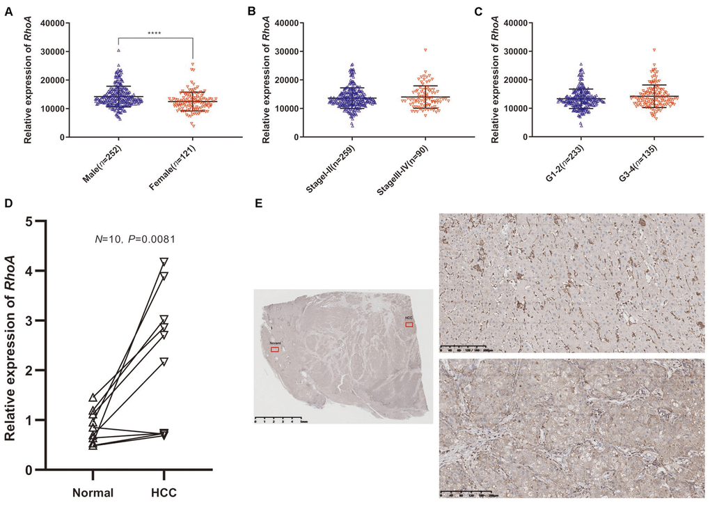 RhoA mRNA expression in different groups of patients and differential expression verification. Relative expression of RhoA in males and females (A), stage I-II and stage III-IV (B), and grade 1–2 and grade 3–4 (C) from TCGA data. The relative RhoA expression in ten pairs of normal tissues and HCC tissues from Peking Union Medical College Hospital identified through real-time quantitative polymerase chain reaction (D). The representative immunohistochemistry images of HCC tissue (lower right) and adjacent normal tissue (upper right): The red squares shown in the figure represents the enlarged area. (E).