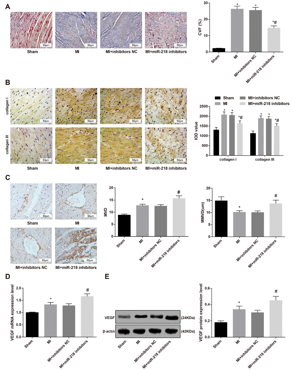 Downregulated miR-218 expression reduces cardiac fibrosis and promotes angiogenesis in MI rats. (A) Masson staining showing the cardiac fibrosis of rats (× 200); (B) immunohistochemical staining showing the expression of type I collagen and type III collagen (× 200); (C) CD34 immunohistochemistry showing MVD and MMVD of cardiac tissues (× 200); (D) the mRNA expression of angiogenesis-related factor VEGF detected by RT-qPCR; (E) the protein expression of angiogenesis-related factor VEGF detected by western blot assay. *versus the sham group, P P 