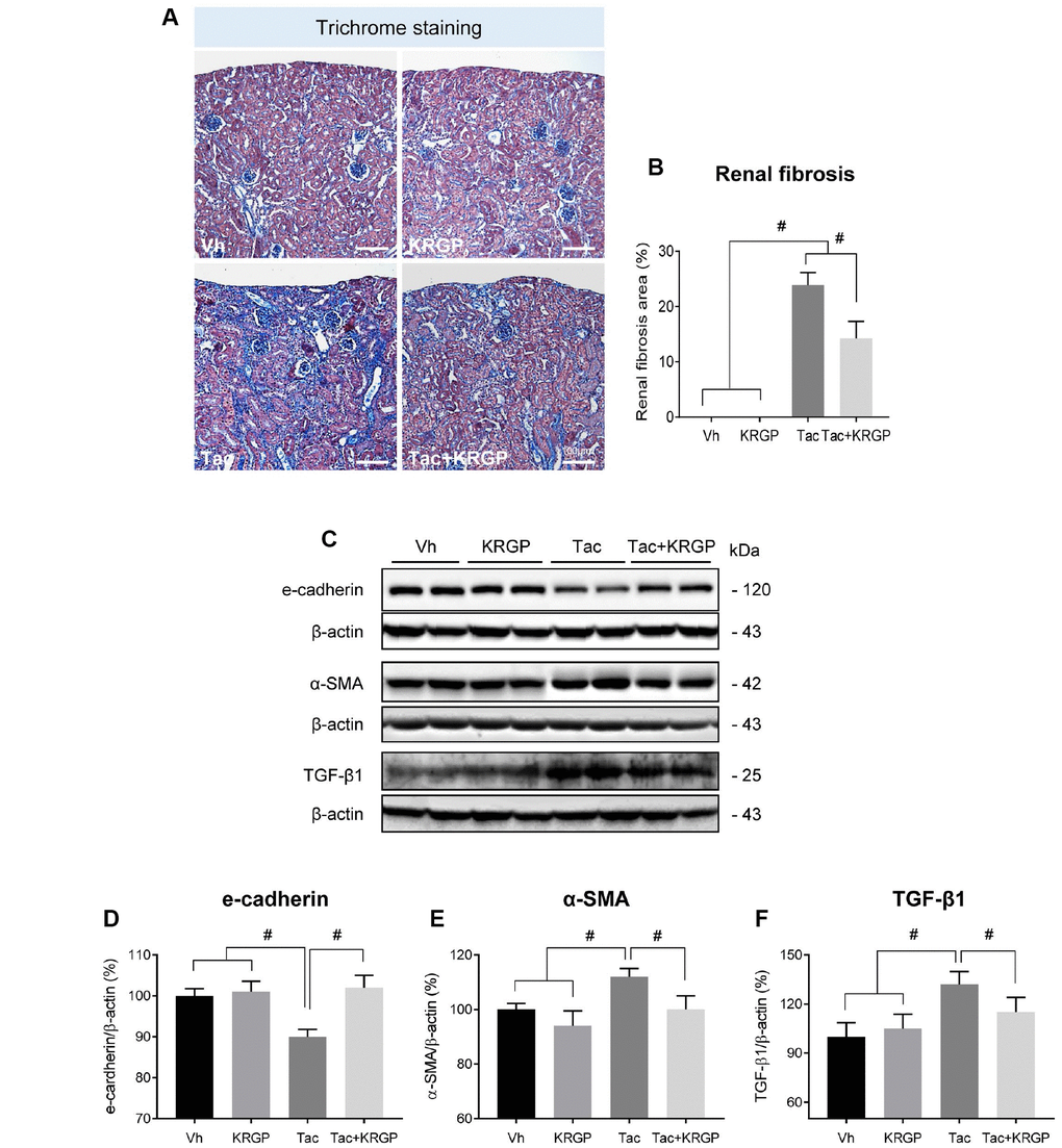 Effect of KRGP administration on Tac-induced renal fibrosis in a mouse model. (A and B) Histological analysis in the renal cortex in mice treated with Tac for 4 weeks showed striped tubulointerstitial fibrosis, mononuclear cell infiltration, and tubular atrophy. KRGP treatment significantly reduced these damages compared with those caused by Tac treatment. (C–F) Immunoblotting analysis of e-cadherin, α-smooth muscle actin (α-SMA), and transforming growth factor β1 (TGF-β1) in the renal cortex. The relative optical densities of bands in each lane were normalized to that of each β-actin band in the same gel. Note that the expression of e-cadherin was restored and that of α-SMA and TGF-β1 was decreased after combined treatment with KRGP. Bar = 100 μm. Data are presented as mean ± SE. n = 8. #P 