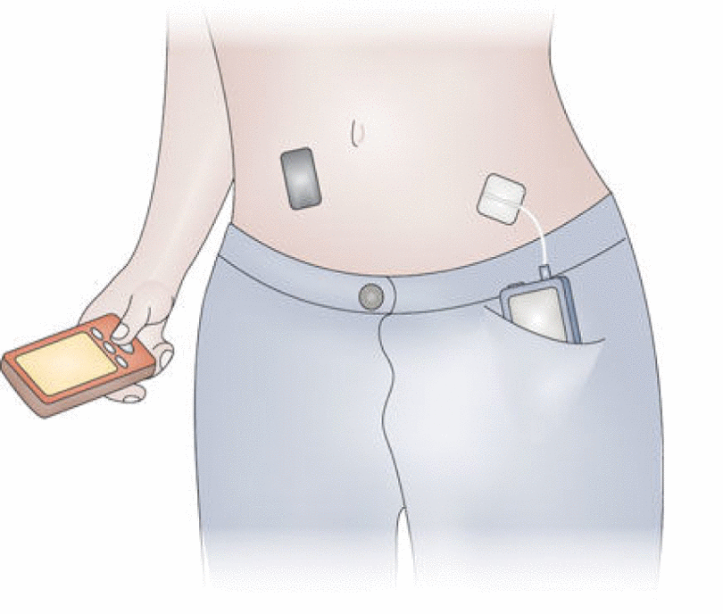 Closed-loop system. A continuous glucose monitor (black device on abdomen) transmits information about interstitial glucose levels to a smartphone (in the hand), hosting a control algorithm. An insulin pump (in the pocket) delivers a rapid-acting insulin analogue subcutaneously. Insulin delivery is modulated in real-time by the control algorithm. Communication between system components is wireless.